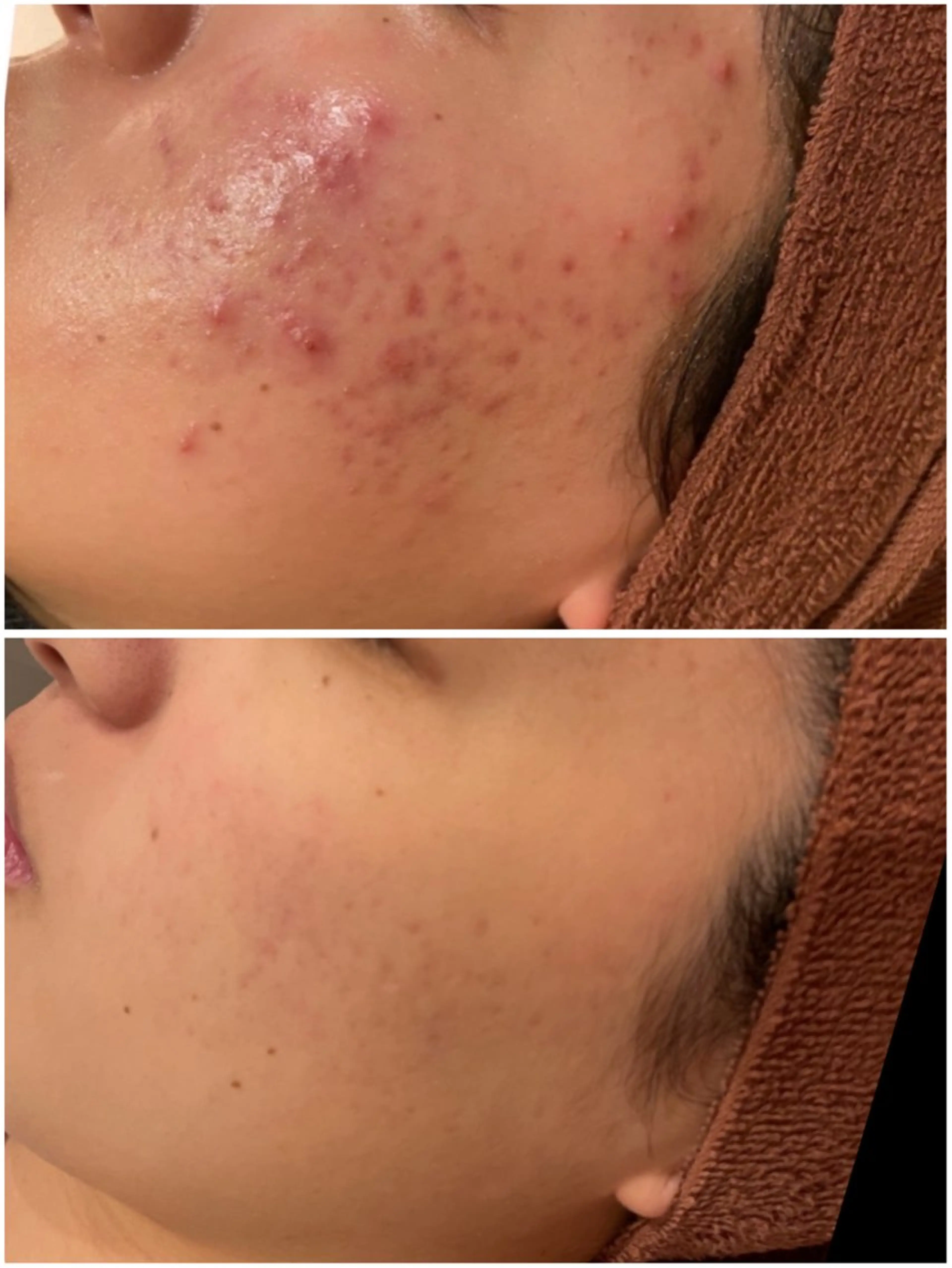 ニキビ特化型エステ 🍓最短で肌質改善のその他イメージ