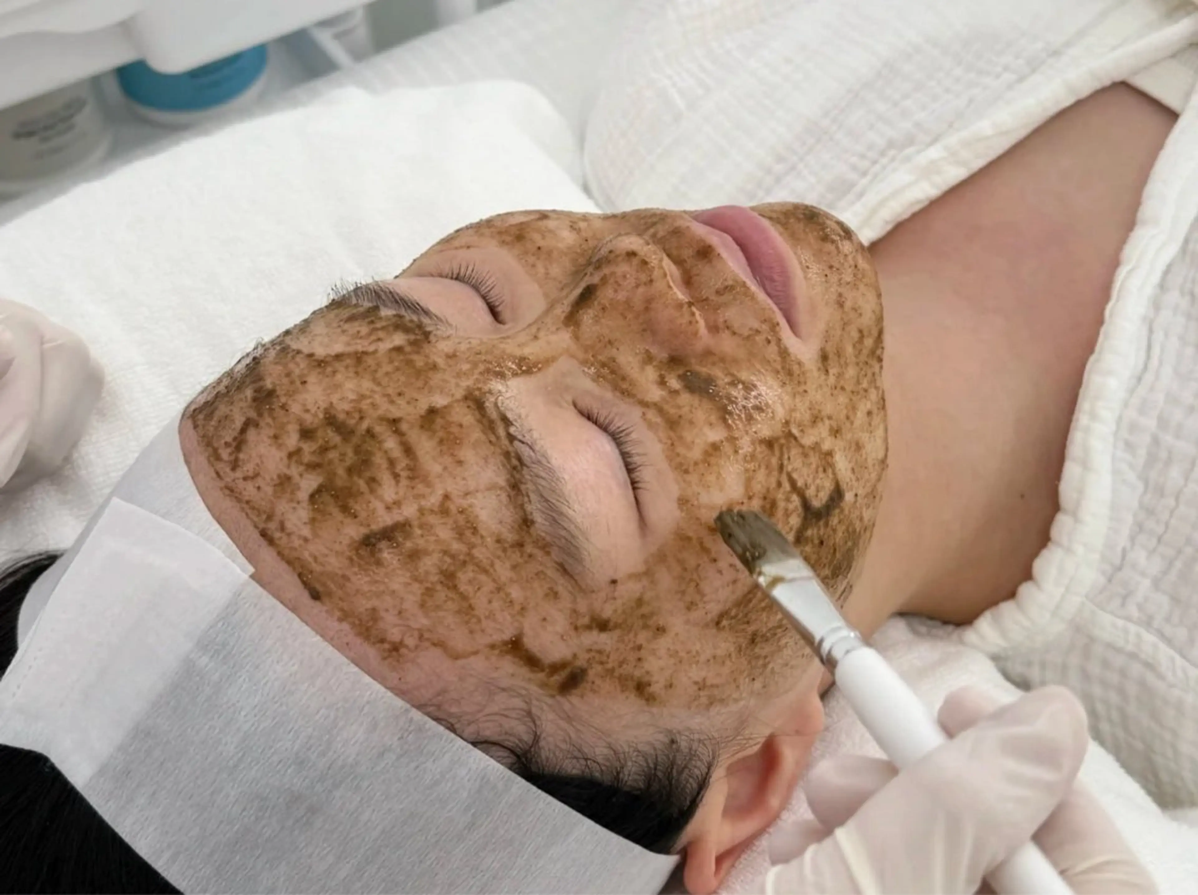 🍀大人気剥離なしハーブピーリング※植物幹細胞ヒト幹細胞培養液配合⅗ニキビ跡撃退!毛穴黒ずみ&小顔ケアキ70分の写真