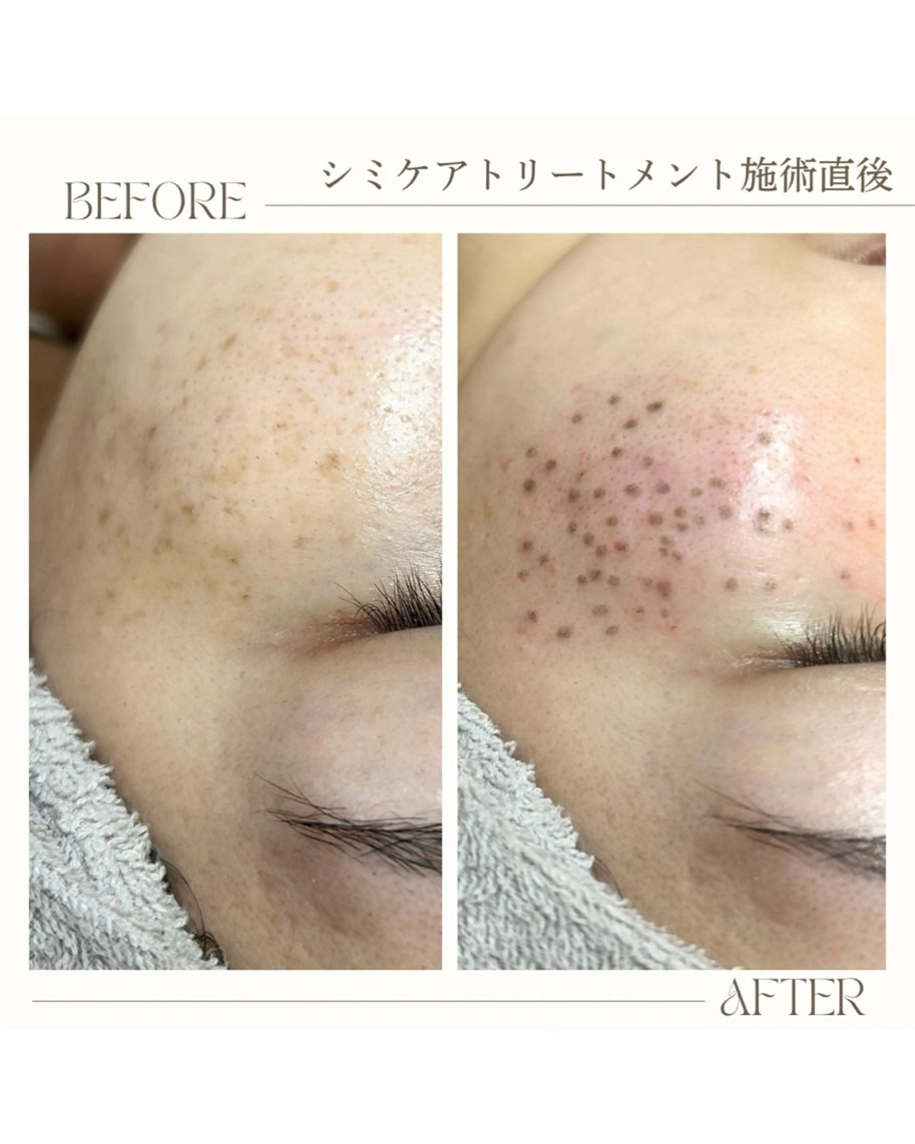 【人気No.1】🌼毛穴洗浄×シミ取り放題30分🌼痛くない低周波シミケア‼️の写真