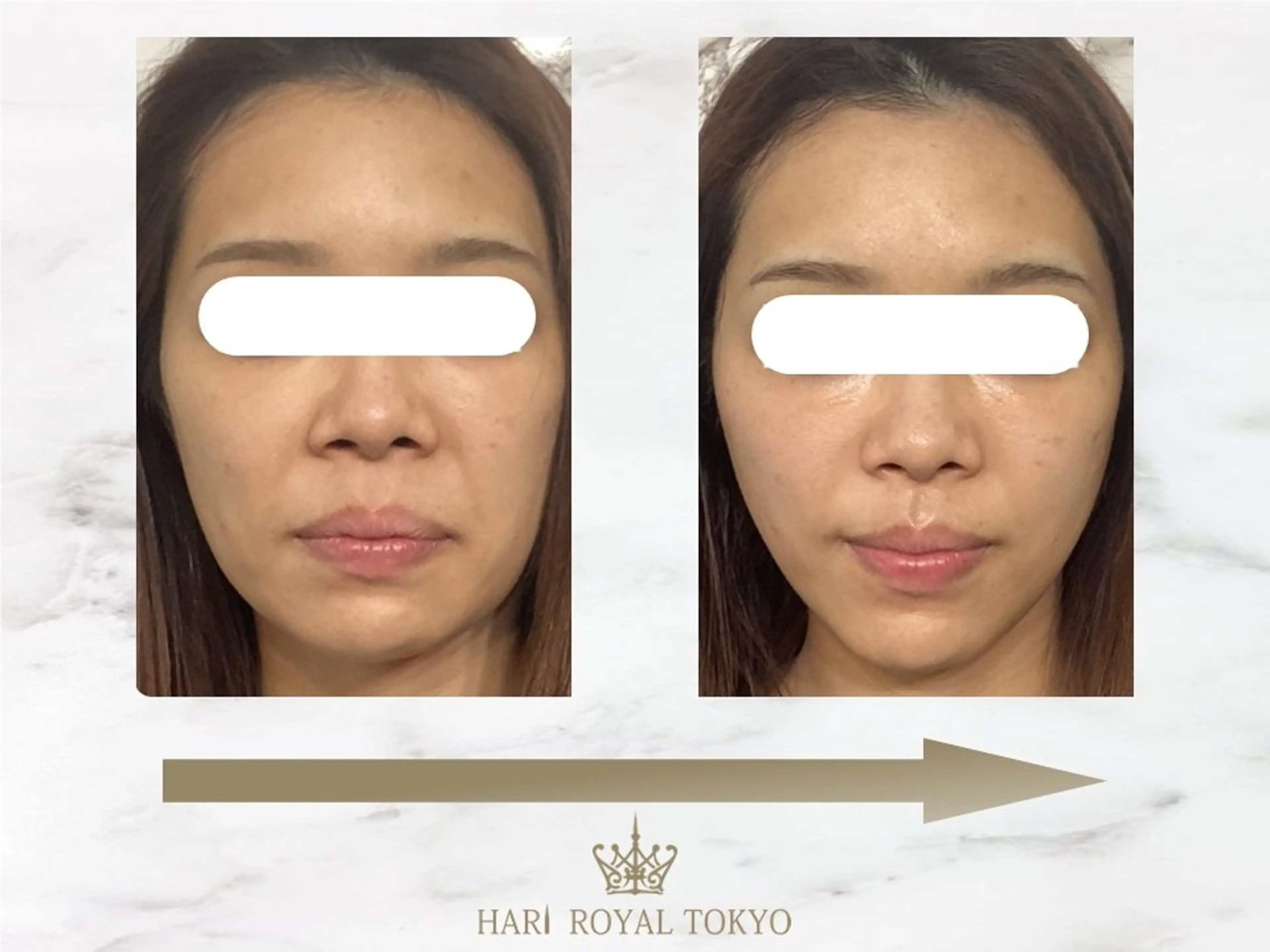 エステ ハリロイヤルトーキョー武蔵小山所属・ニューハーフ鍼灸師 🖤🤍Saya🌹のエステ・リラクイメージ