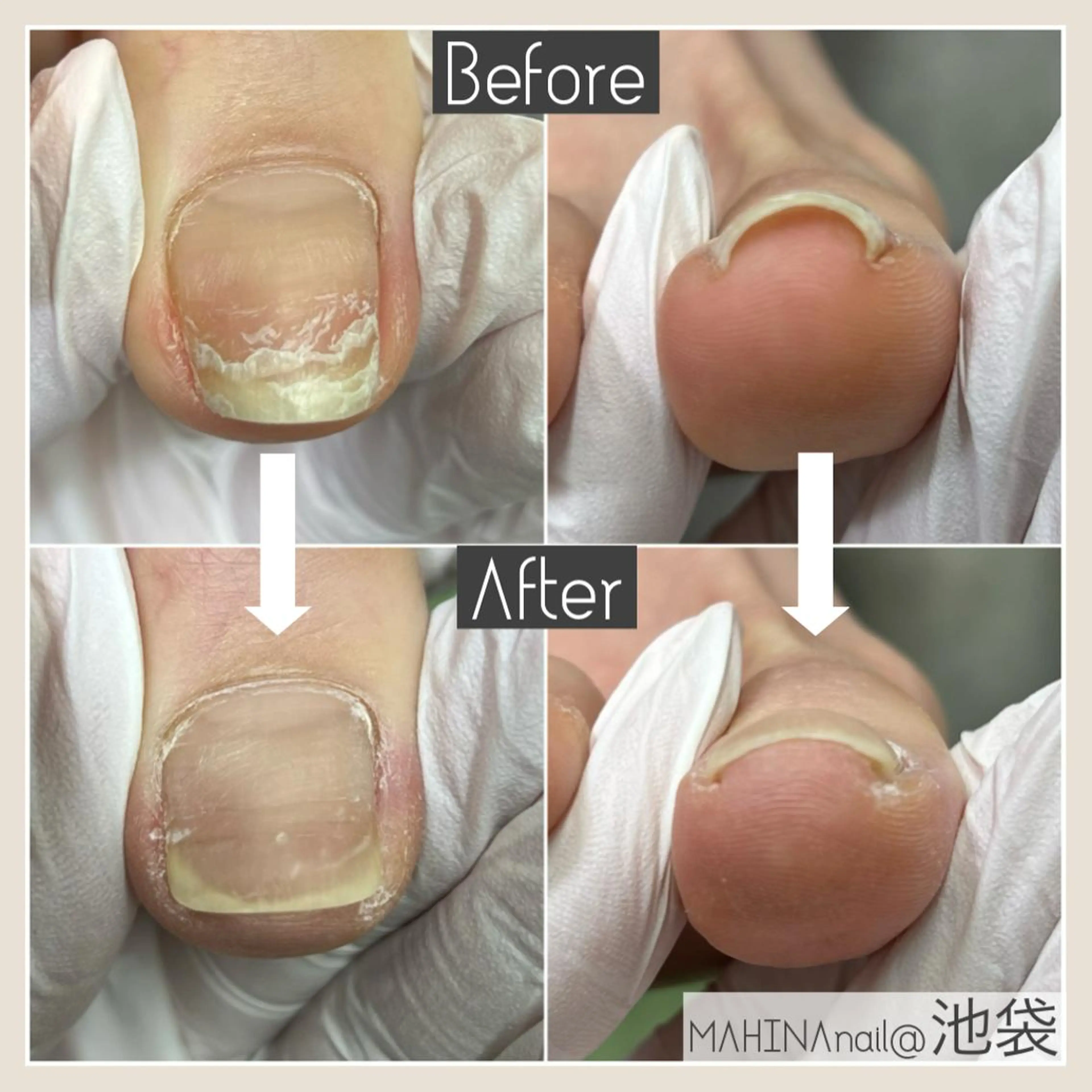 痛い巻き爪にも❗️両足がお得👍🏼巻き爪ケア両親指¥9900の写真