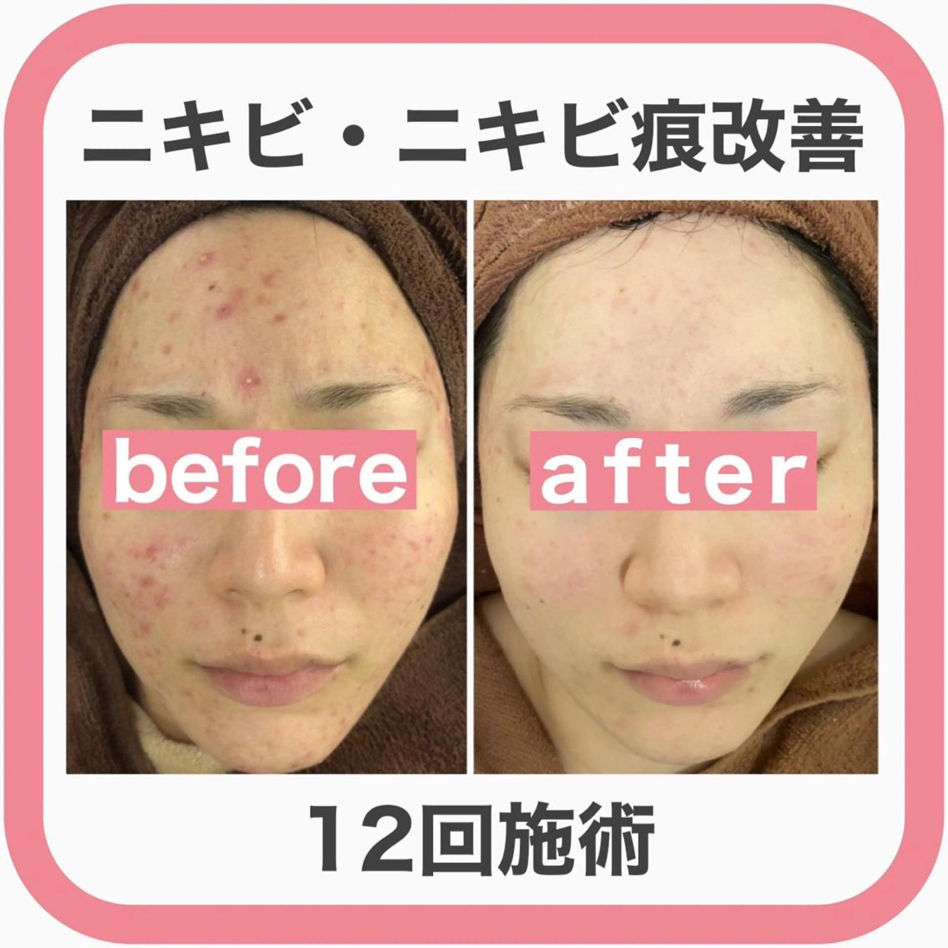 セミロング カラー パーマ ヘアアレンジ メンズ キッズ ネイル マツエク・マツパ アイブロウ 🔥3か月で肌革命 🔥ニキビ専門店のエステ・リラクイメージ