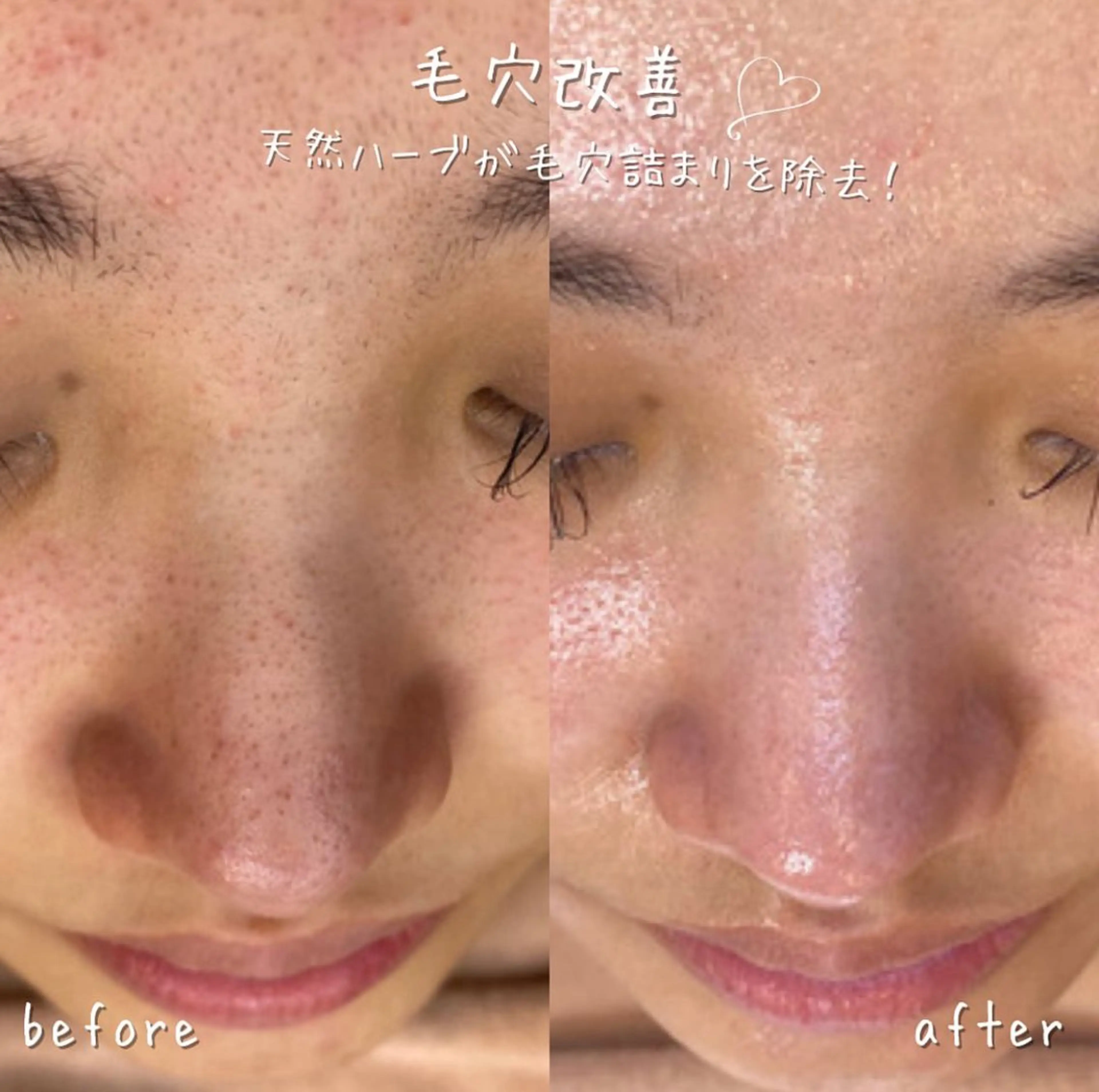 【毛穴特化】REVIハーブピーリング（1g）＋毛穴洗浄付き（1部位）の写真