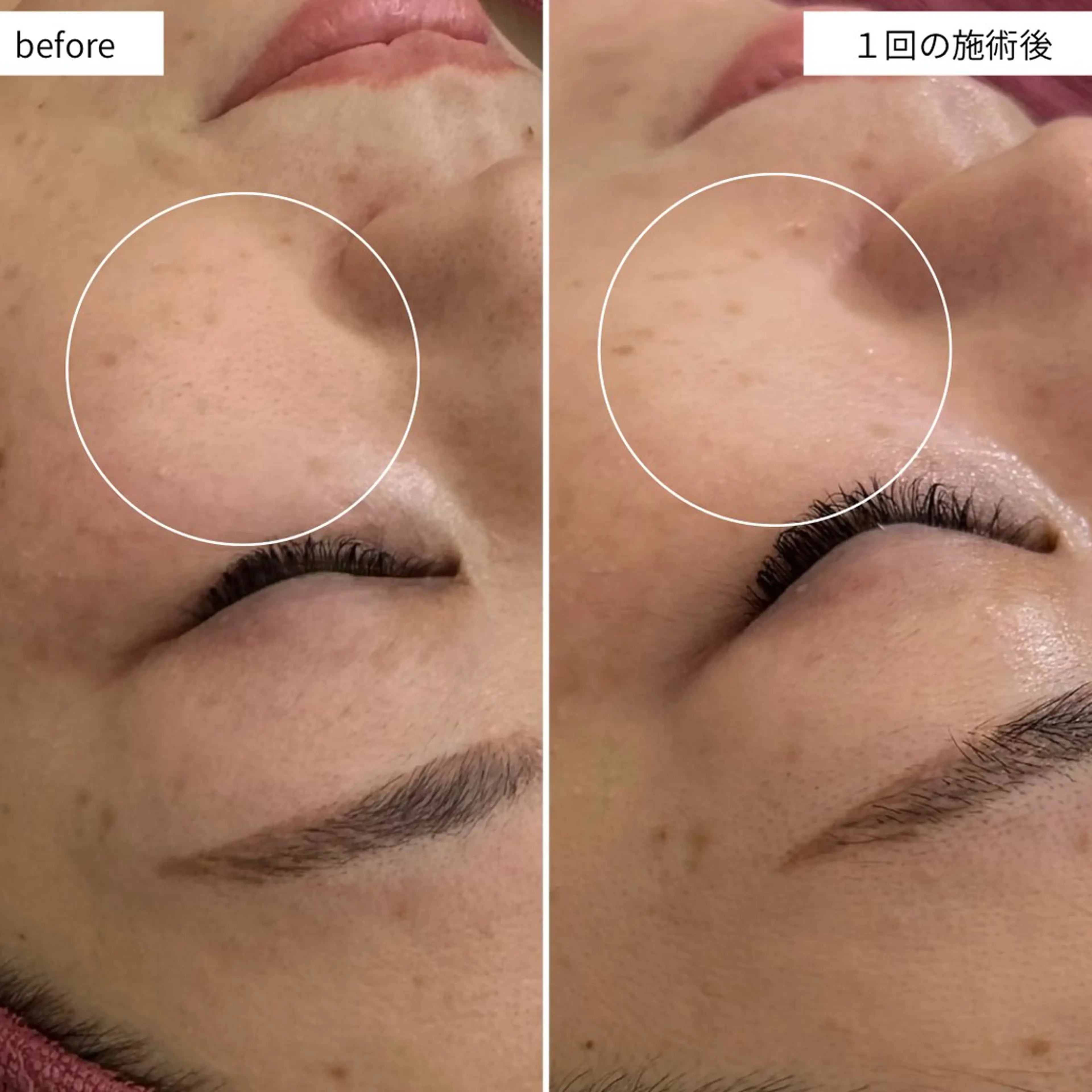 エステ シミ取り*韓国肌 エステサロン✶クロヌのエステ・リラクイメージ