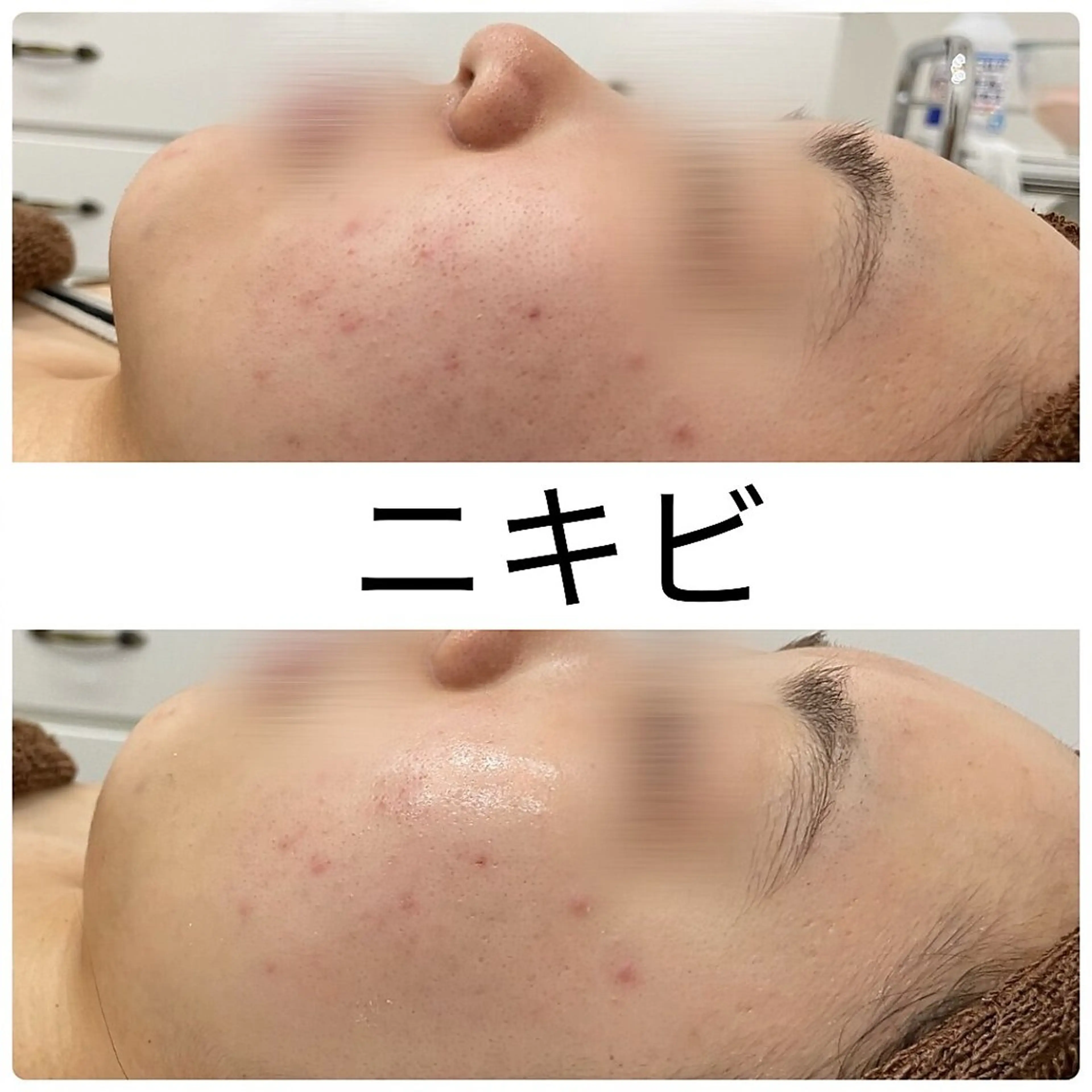 ビタミンC高配合【ニキビケア】剥けないハーブピーリング¥18,700→13,200(生酵素&VCF)の写真