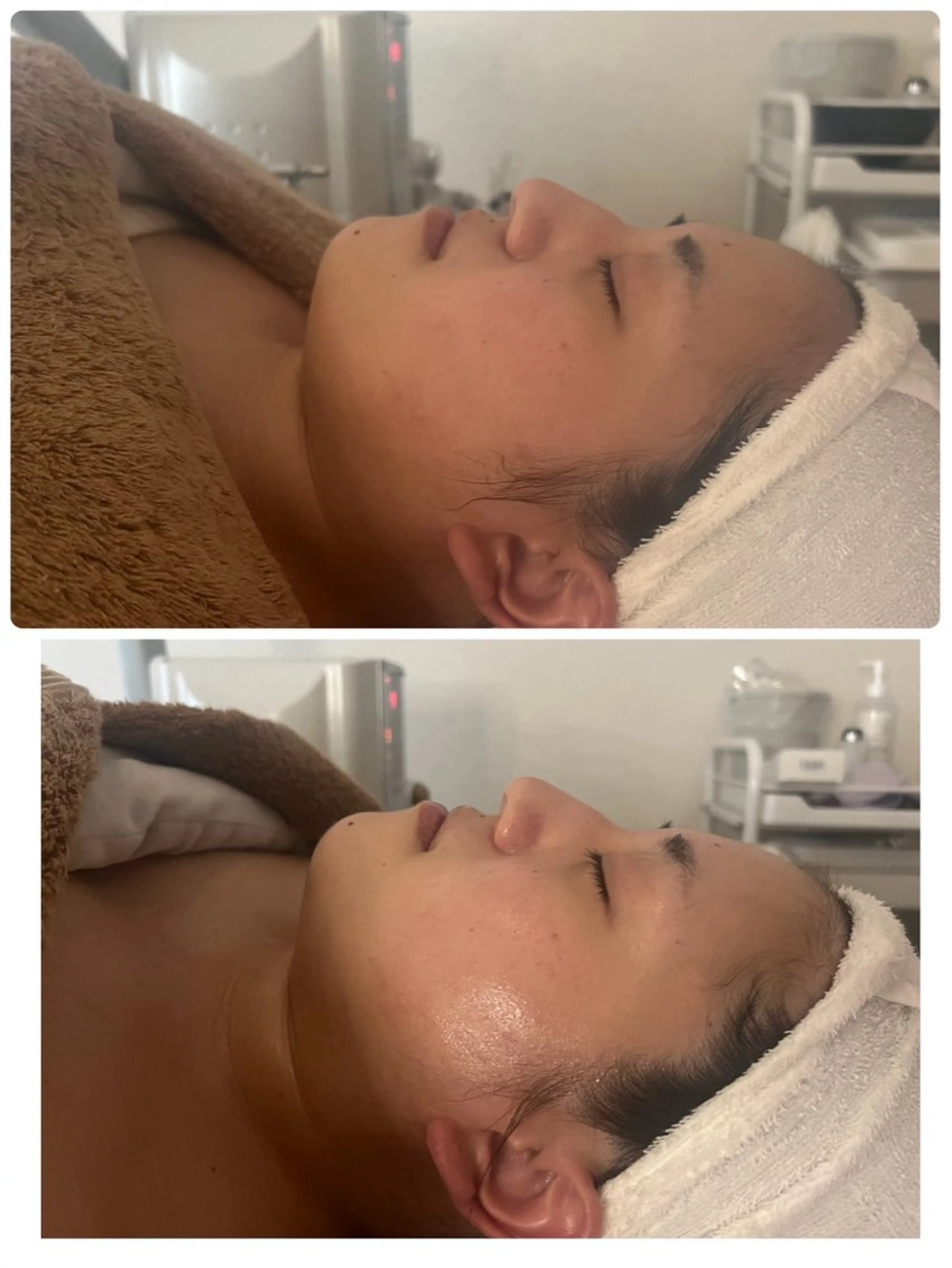 【シワ改善】リフトアップコースの写真