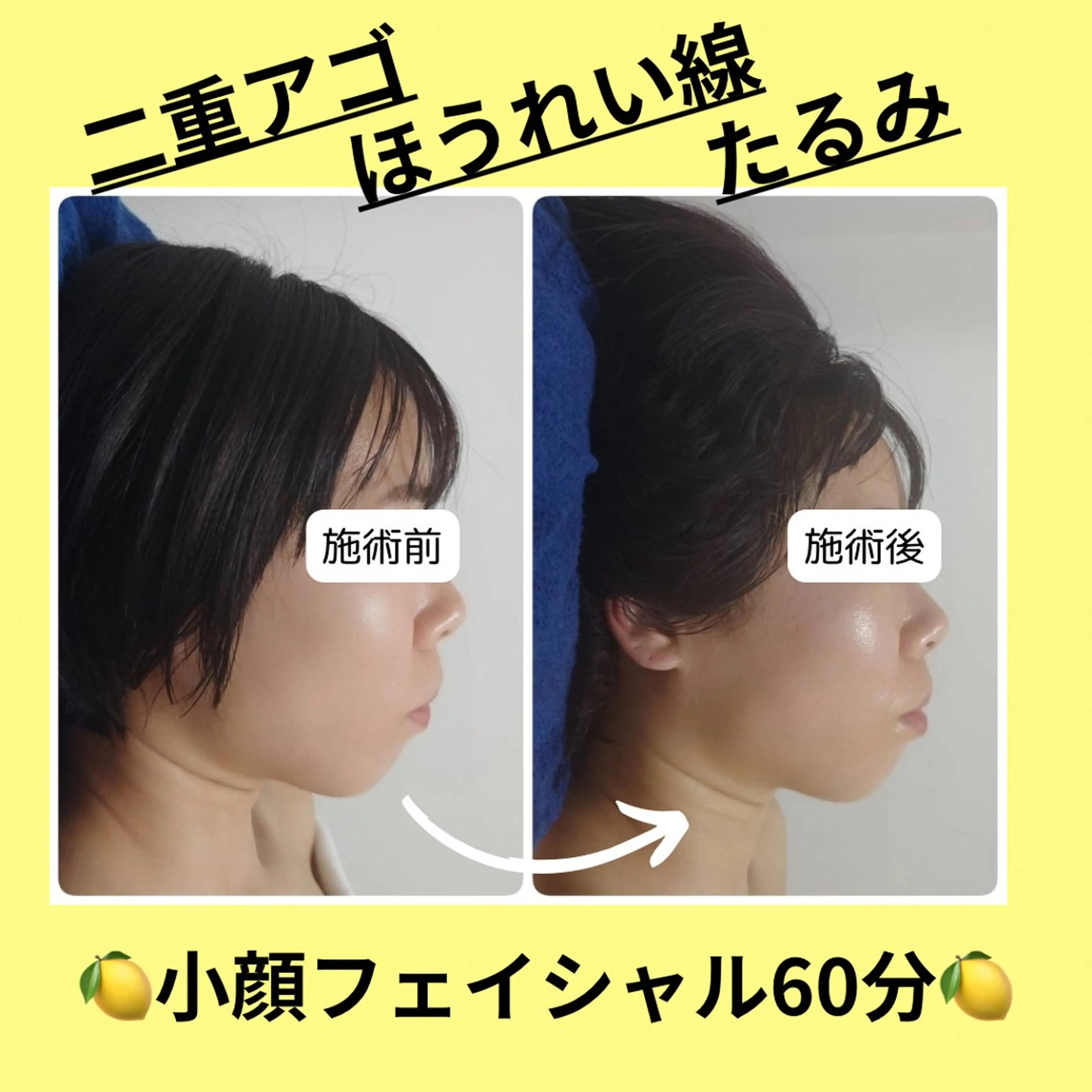 【大人気】韓国発🇰🇷美容液導入🍋小顔フェイシャル60分の写真