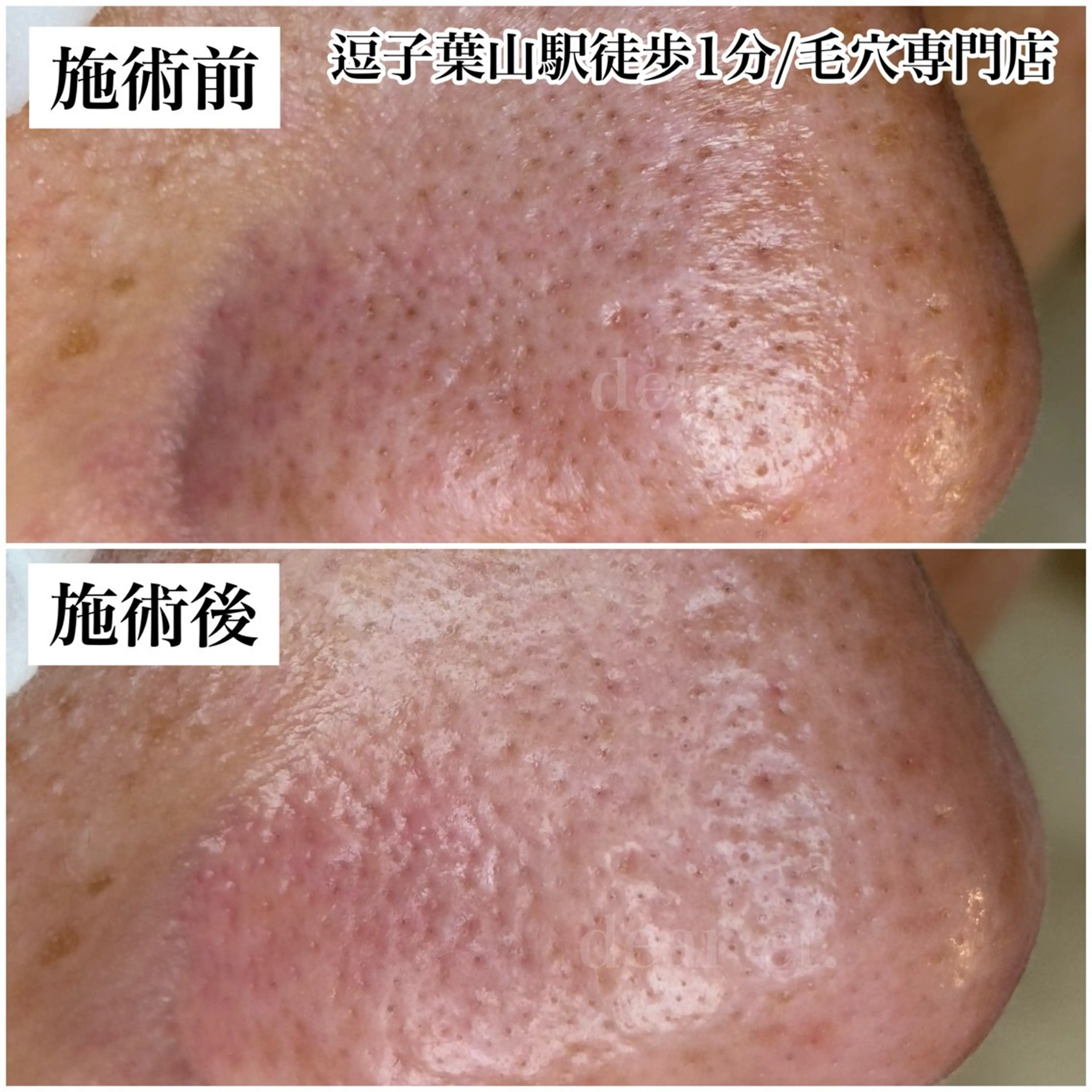 毛穴美コース　お着替えなし70分　通常12,000円→初回10,000円の写真