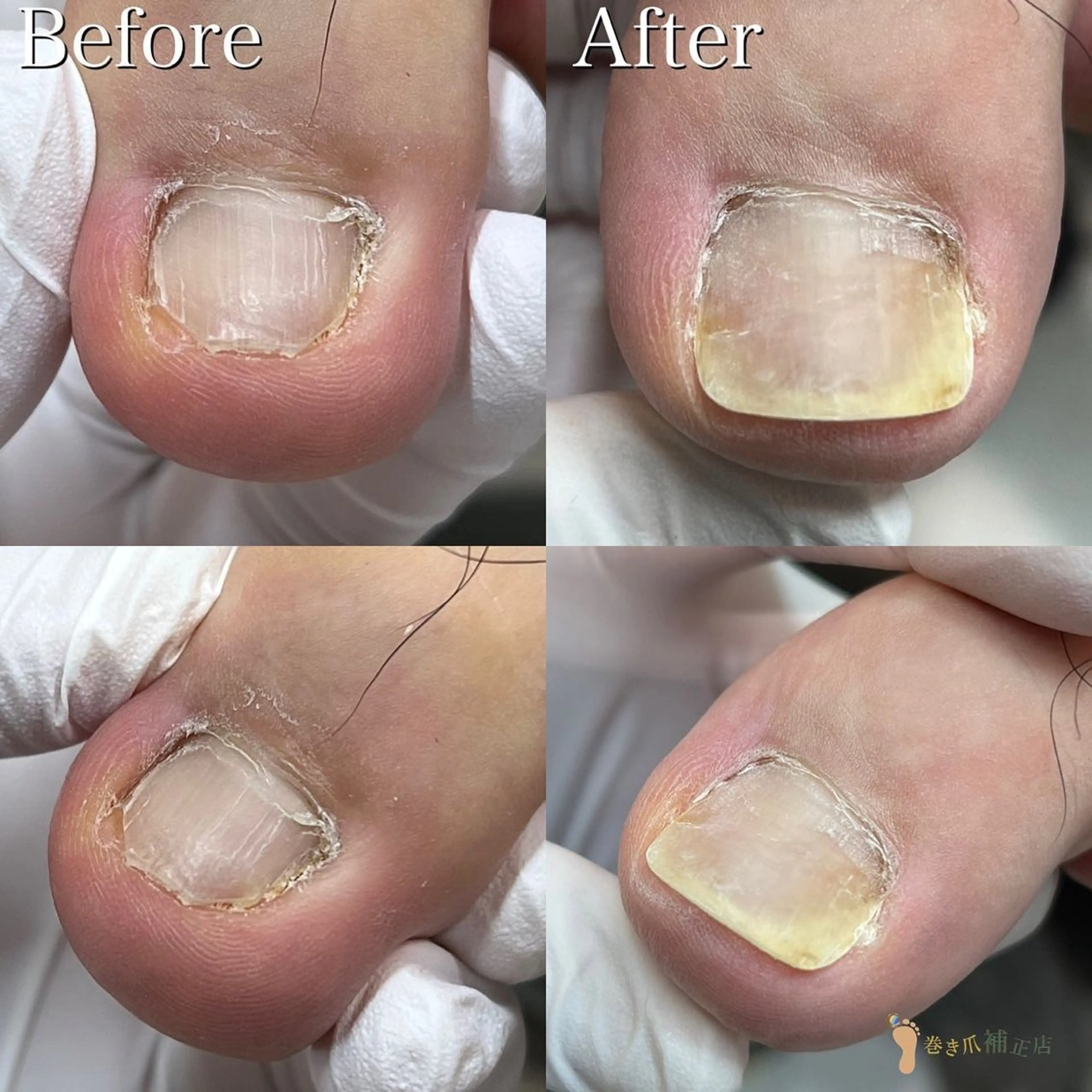 『陥入爪』朗報✨初回お試し料金1爪施術料がなんと🉐¥1000🉐の写真