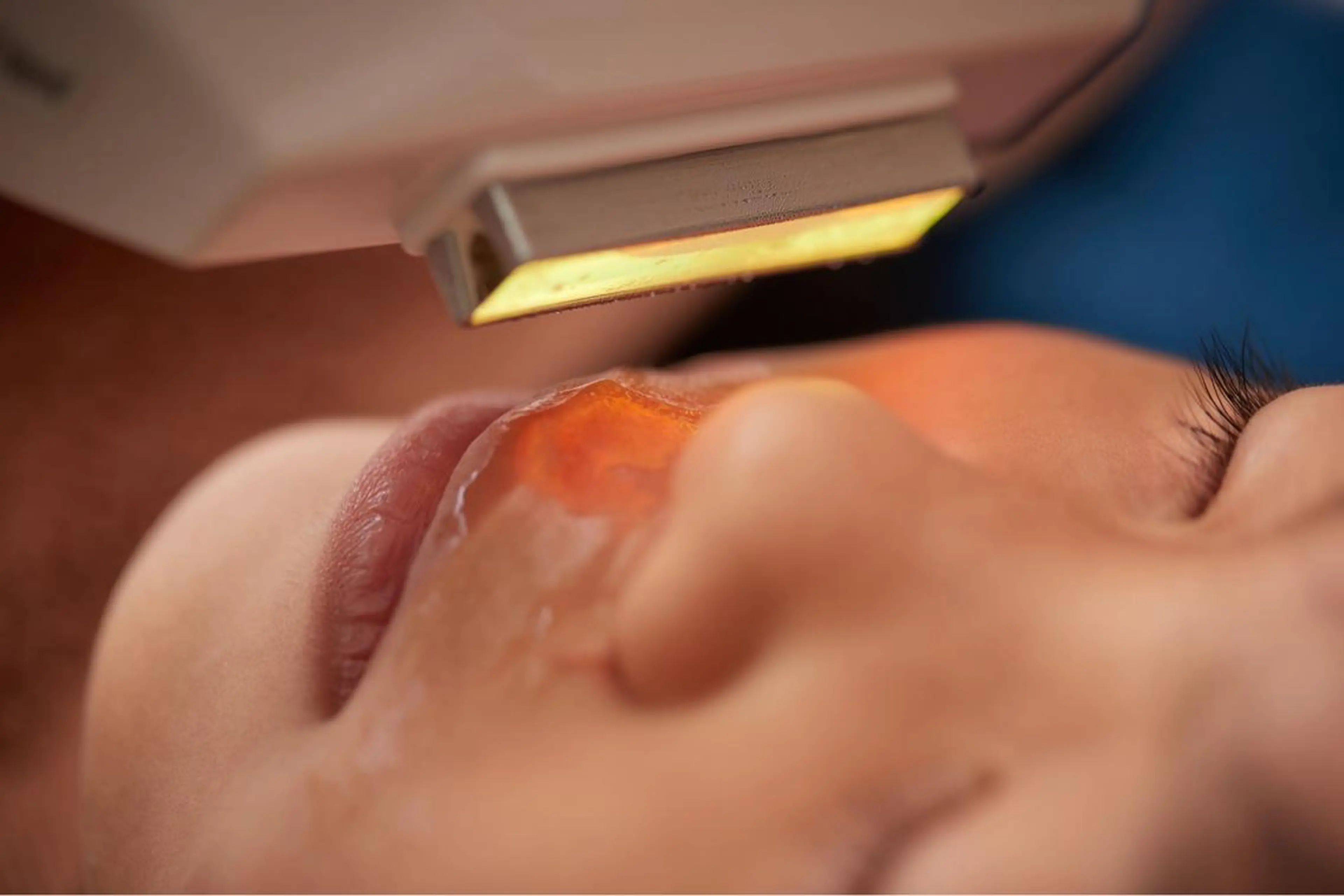 美楽鍼 びらくしんのその他イメージ