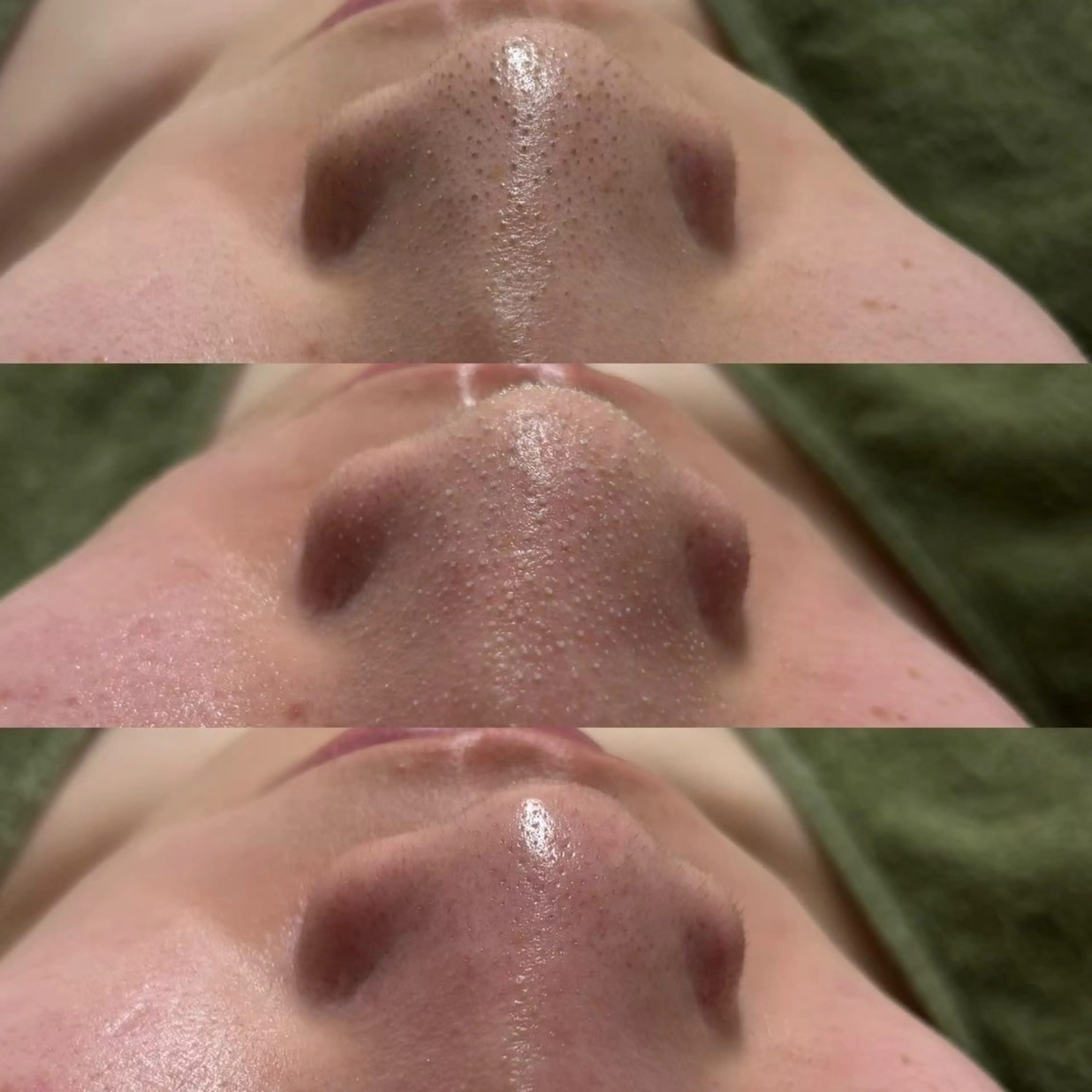 鼻,顎,眉間の気になる部分の角栓,黒ずみ除去【溶ける毛穴吸引＆洗浄】￥5980の写真