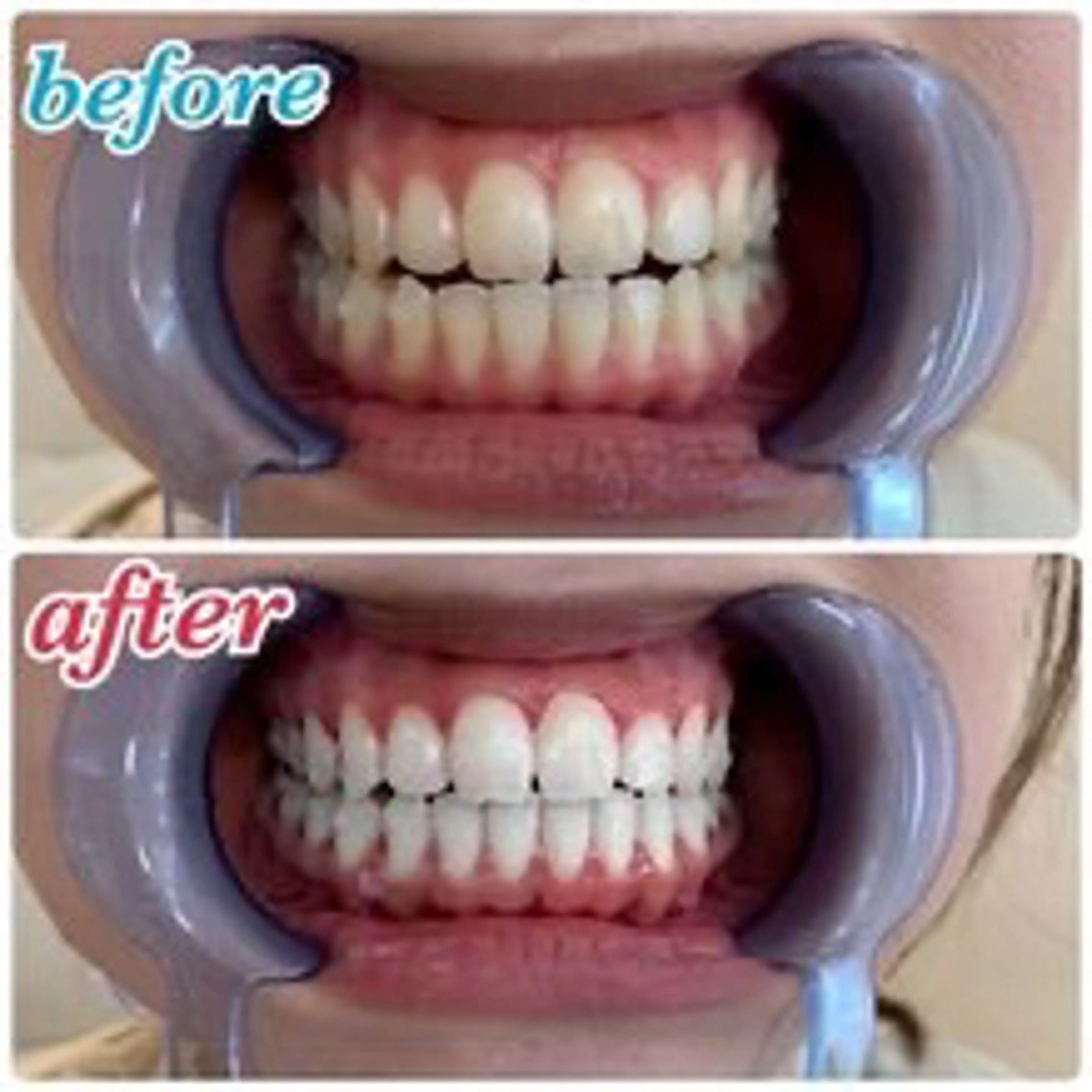 その他 ecxia white 高田馬場所属・セルフホワイトニング エクシア 高田馬場のその他イメージ