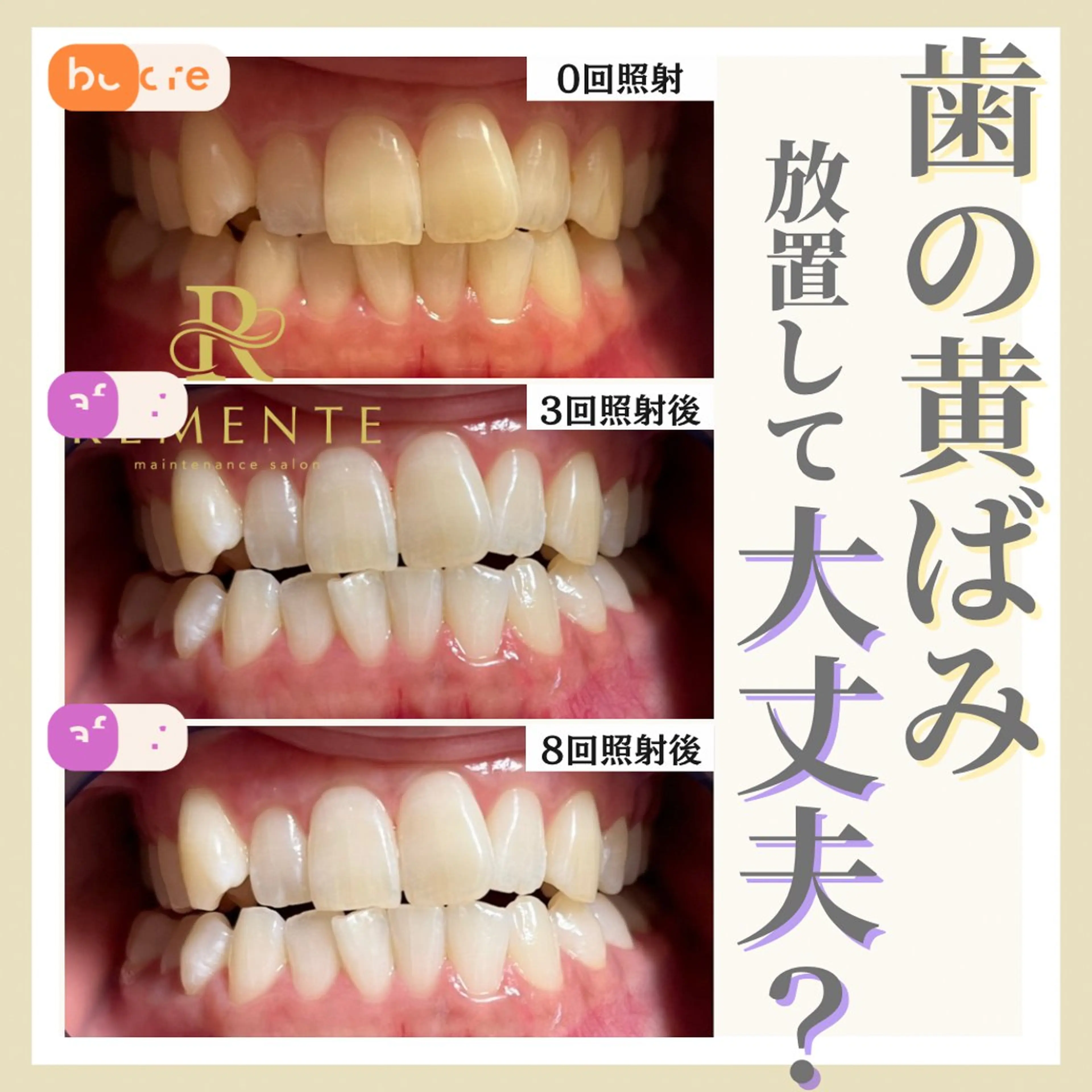 ⭐️初回限定⭐️口コミ記載で無料体験!お試しセルフホワイトニング🦷照射パワーMAX20分照射🔥✨の写真