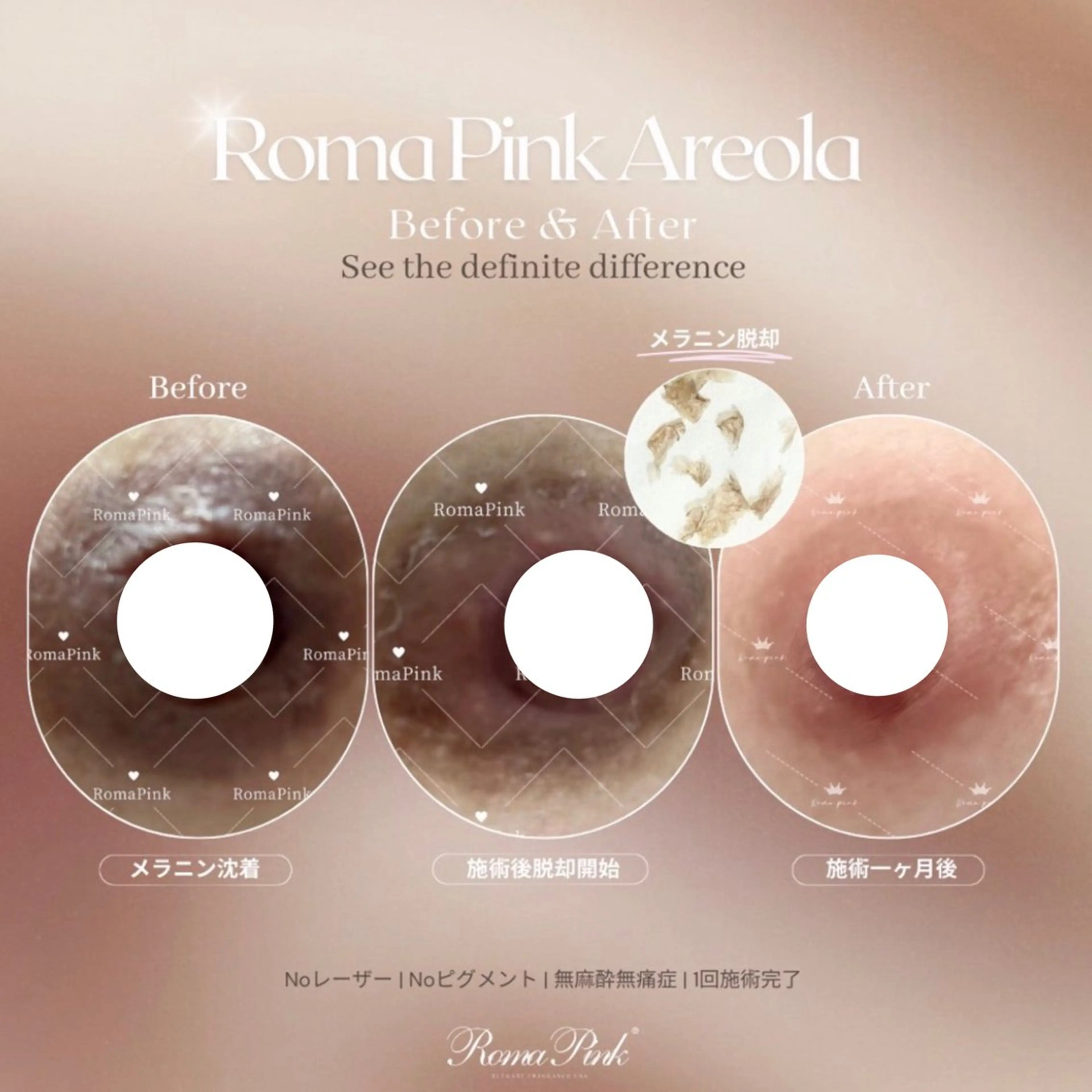 業界で話題！山梨初上陸🎀✨【ローマピンク💋】乳輪/乳頭¥200,000→¥120,000✨※アフタークリーム1本付の写真