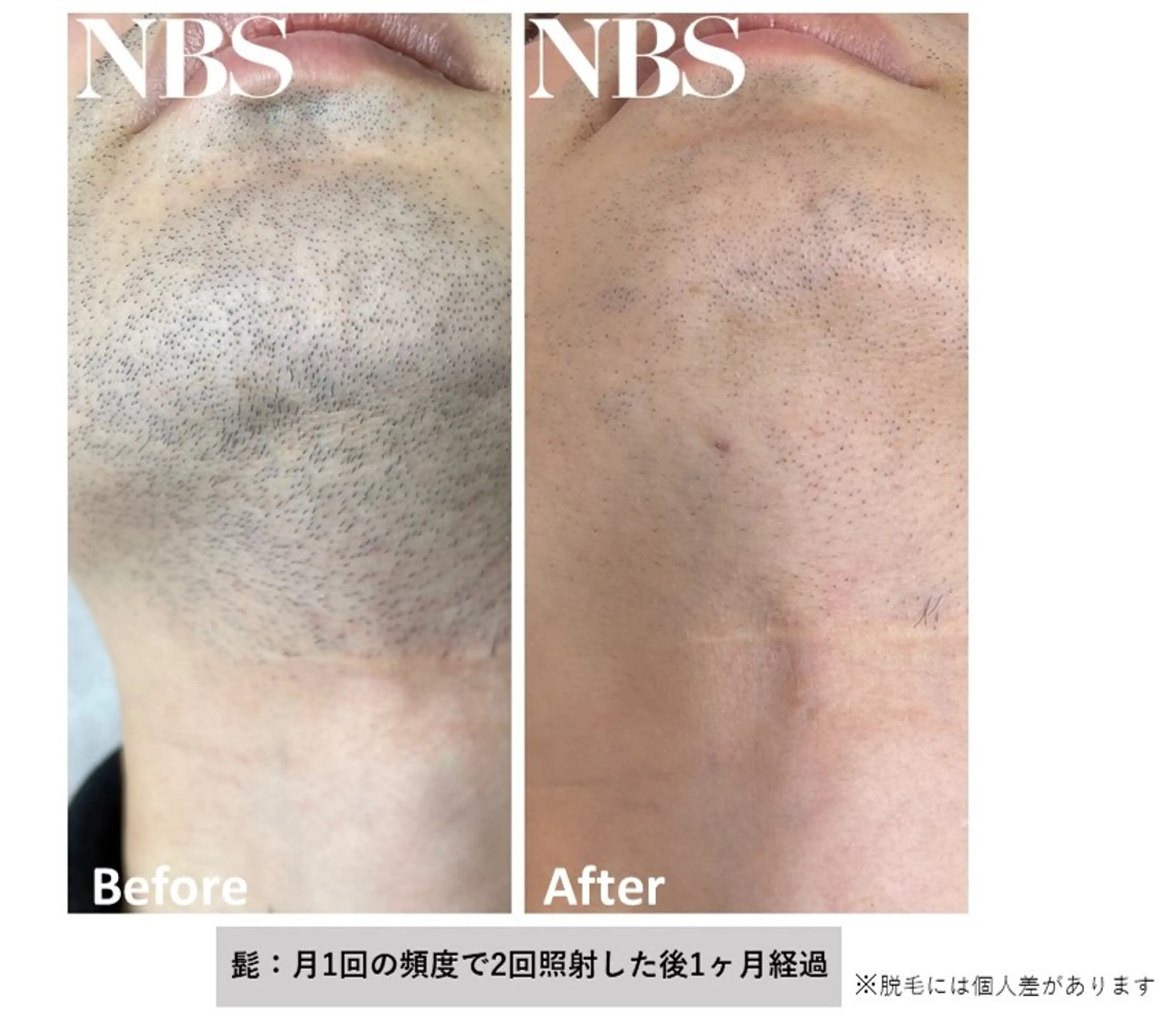 初回/メンズ限定！ヒゲ脱毛(全顔)1回¥7,700→¥6,600の写真