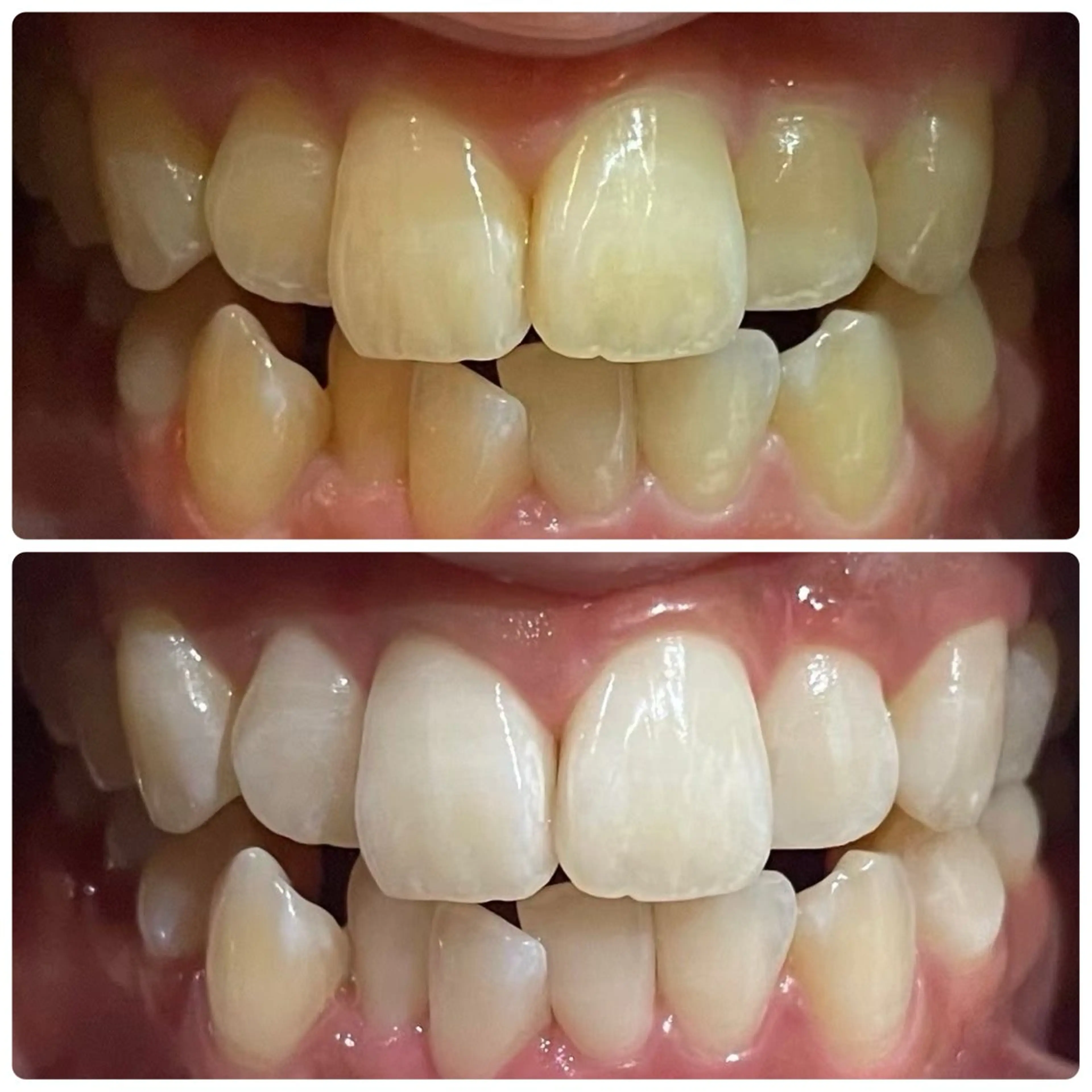 【当日限定✨】セルフホワイトニング体験メニュー！歯の黄ばみに！8分x3回で効果実感セルフで簡単本格ケア🥰の写真