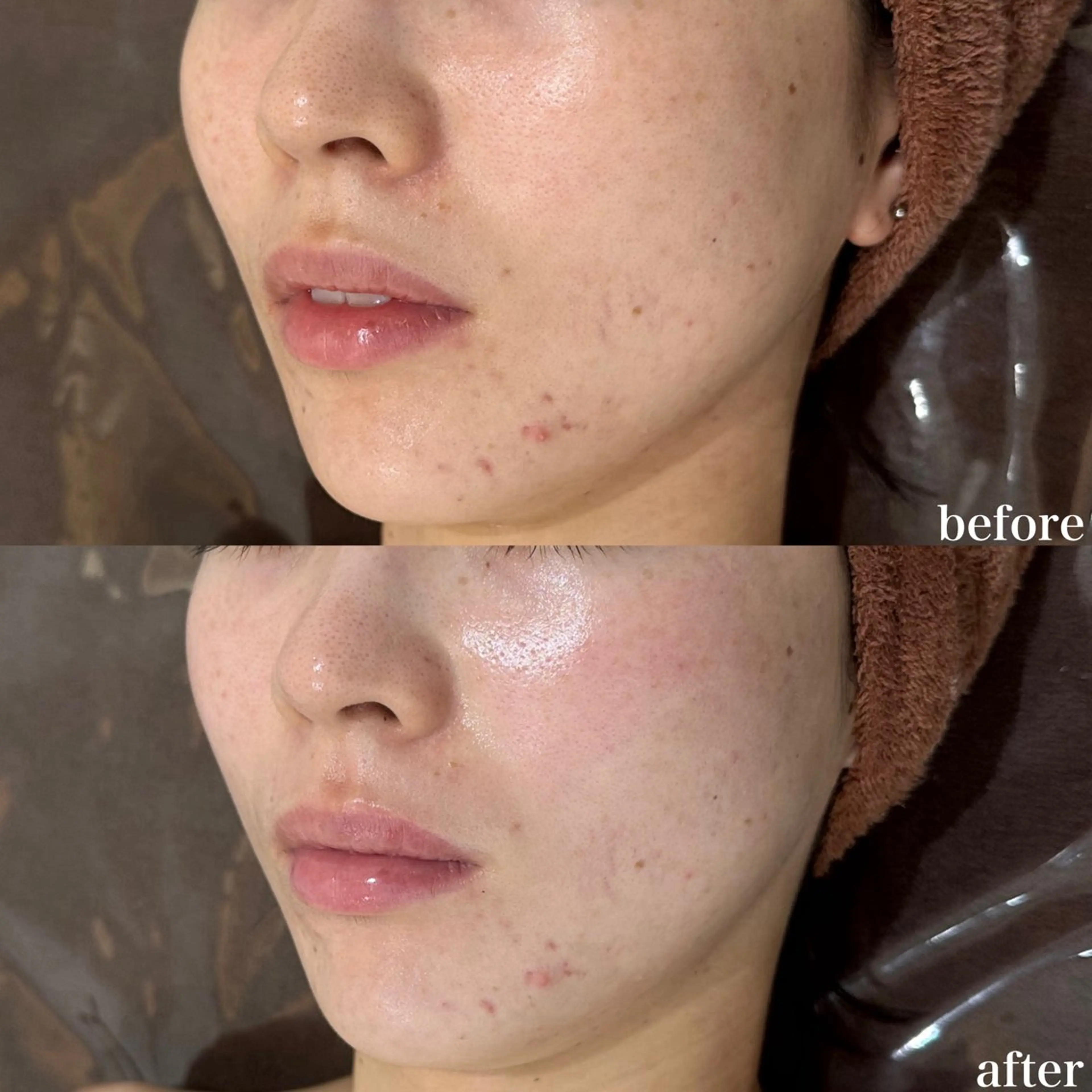 mieux所属・ハーブピーリング ¥6600のエステ・リラクイメージ