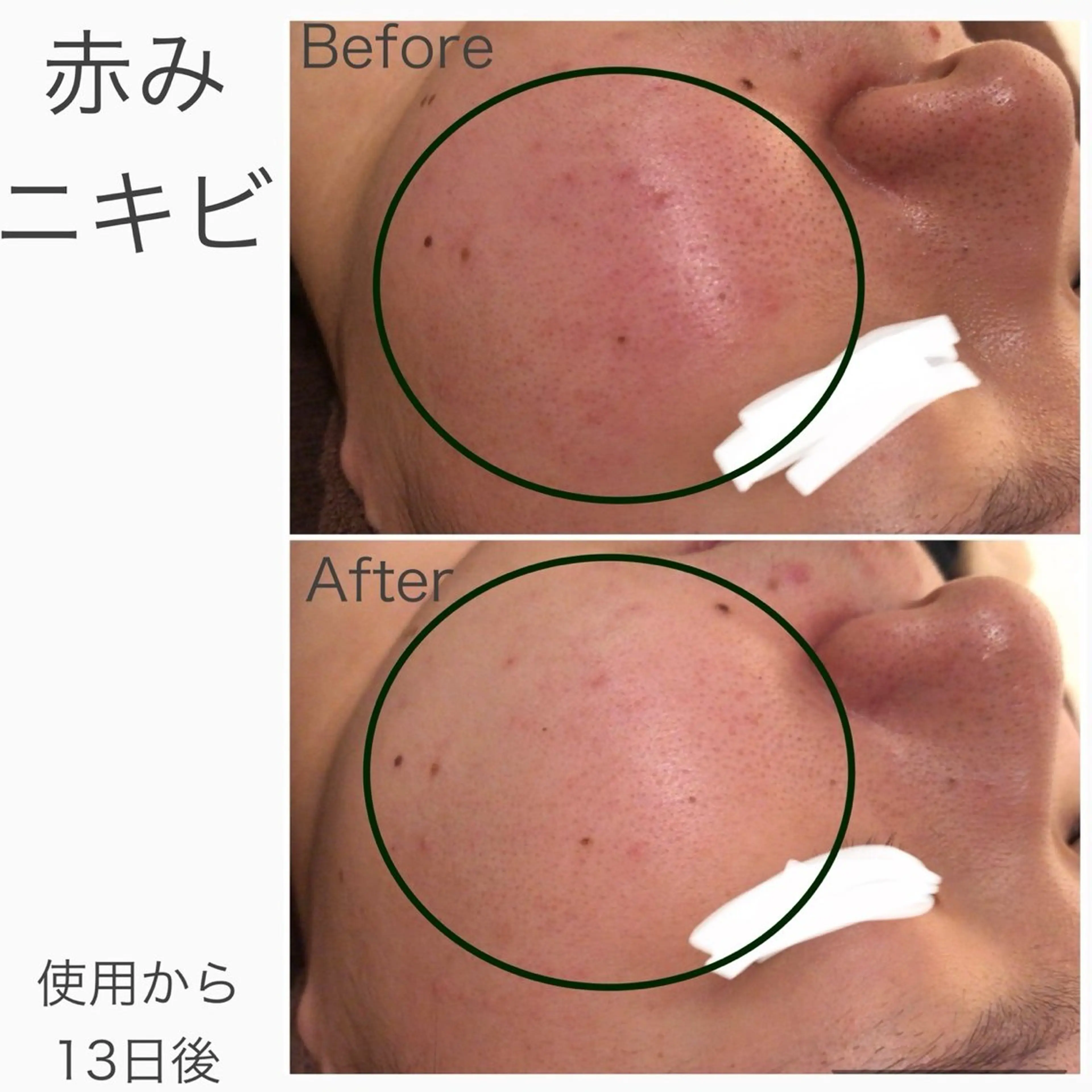 学生ニキビ改善🍀 優しい肌質改善のエステ・リラクイメージ