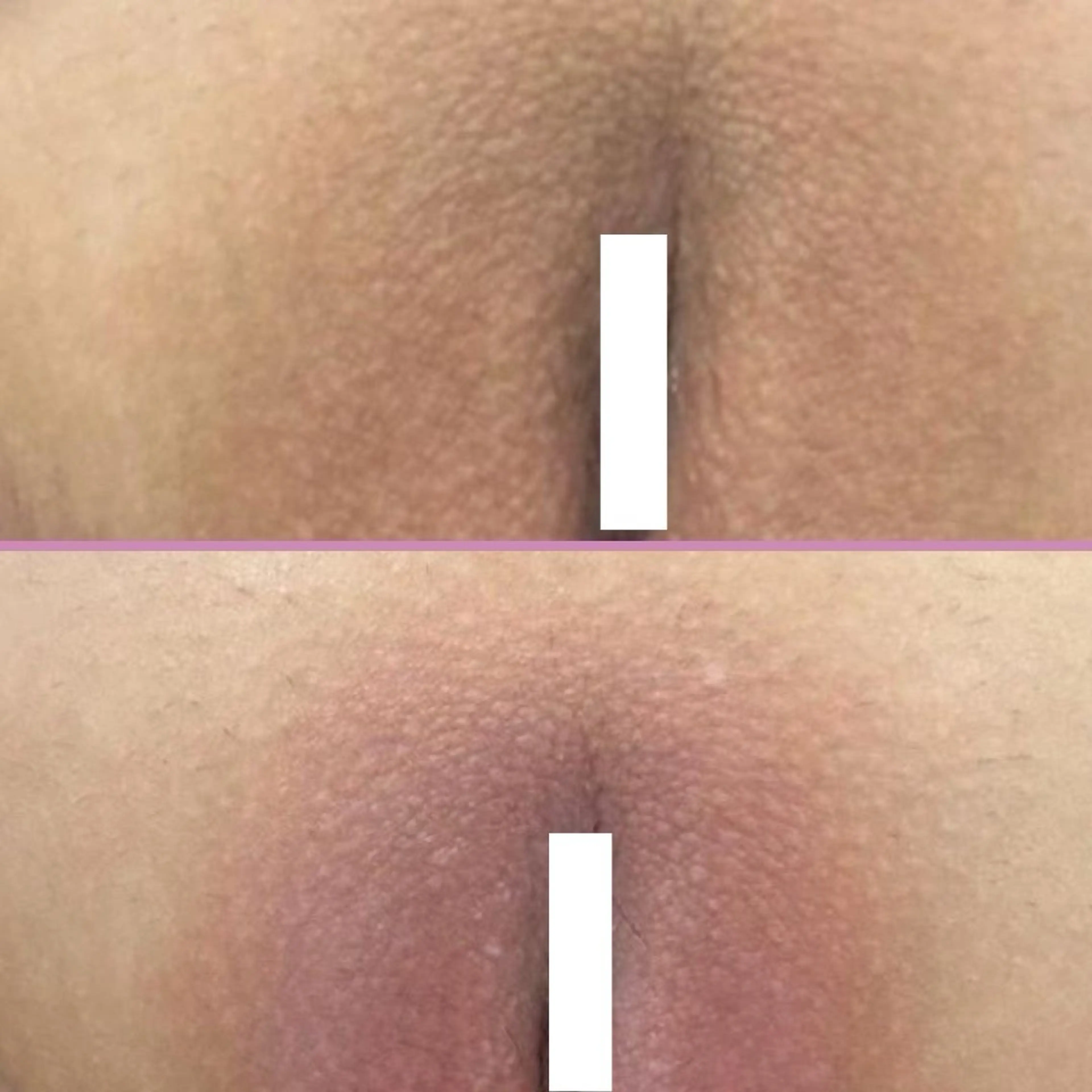 ローマピンク【Vラインor外陰部Iライン】　モニター特別価格40%OFFの写真