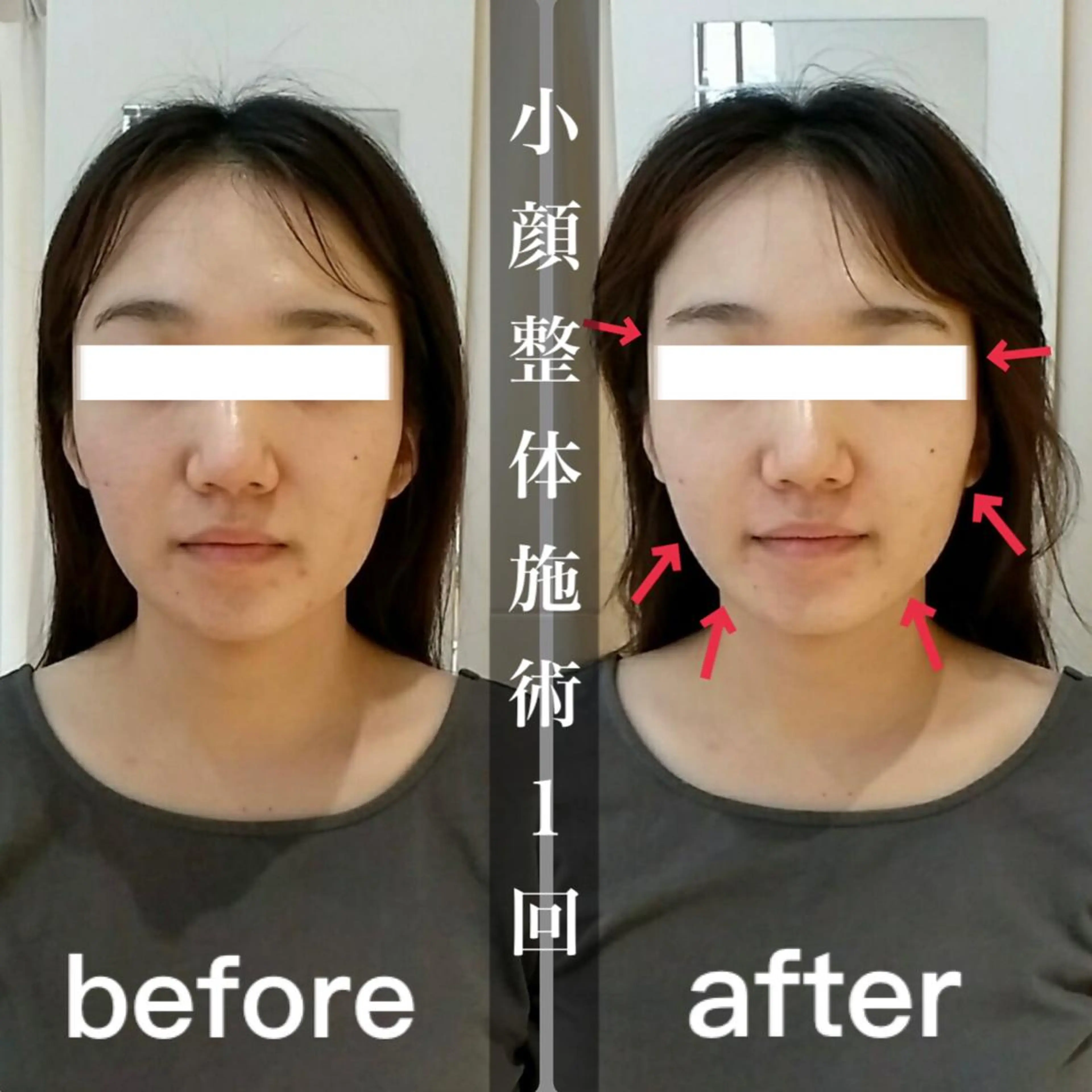 鍼灸整骨院Refine所属・鍼灸 Refineのその他イメージ