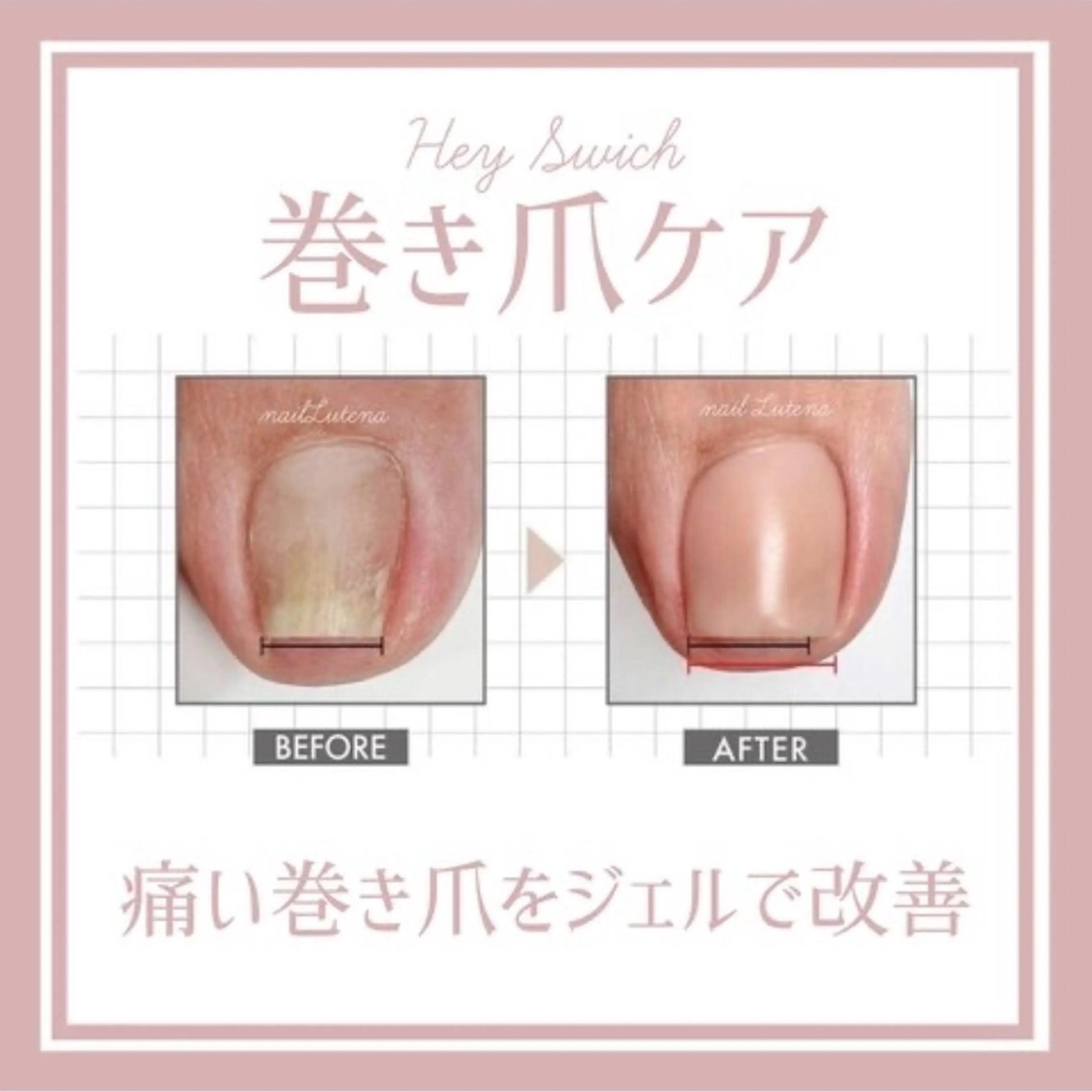 【フット親指巻き爪ケア＊Hey Switch】特殊な専用ジェルで痛みなくゆっくり時間をかけてケアします！の写真