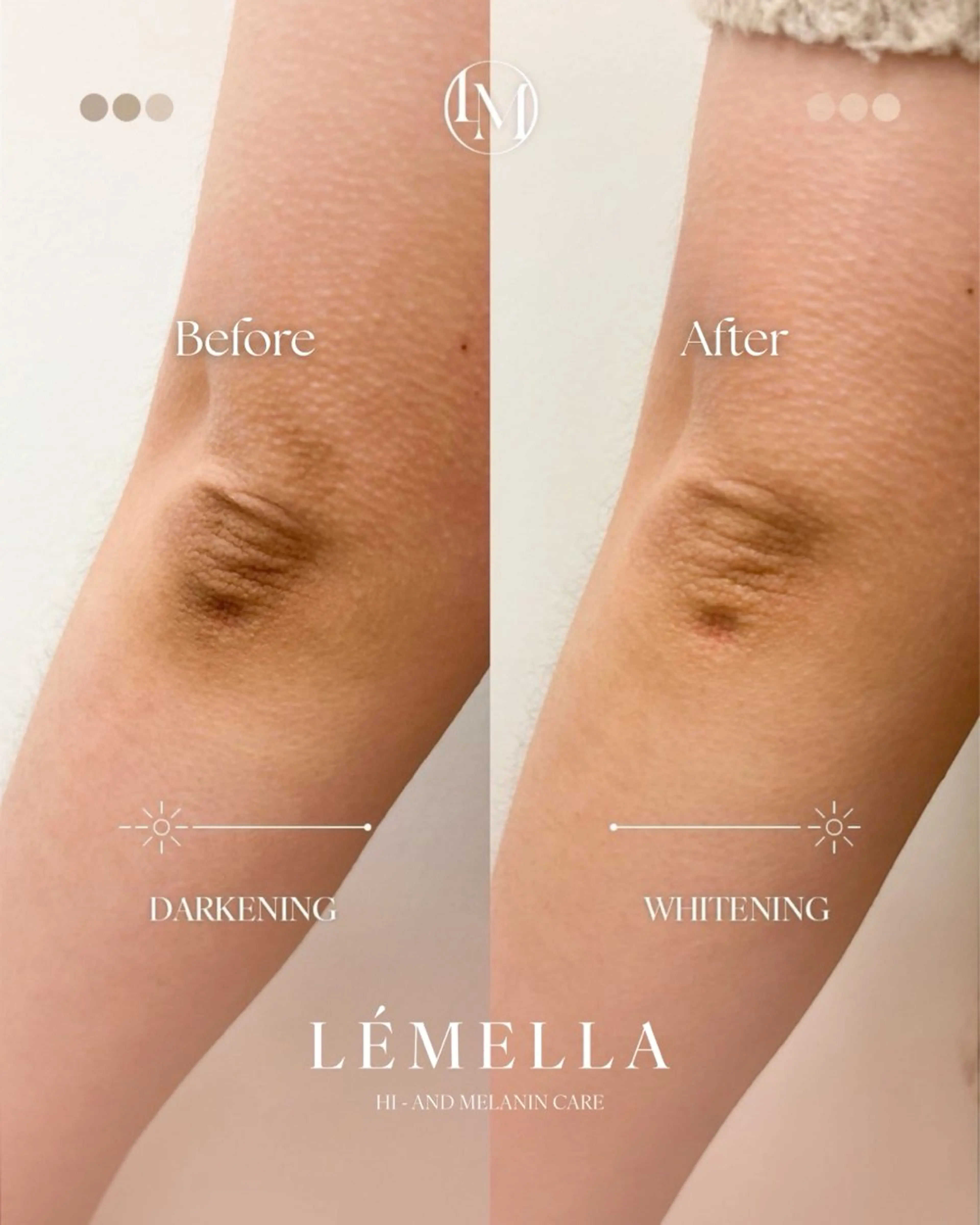 \韓国シェアNO.1/話題のLÉMELLA（ルメラ）メラニンケアモニター価格【肘】の写真