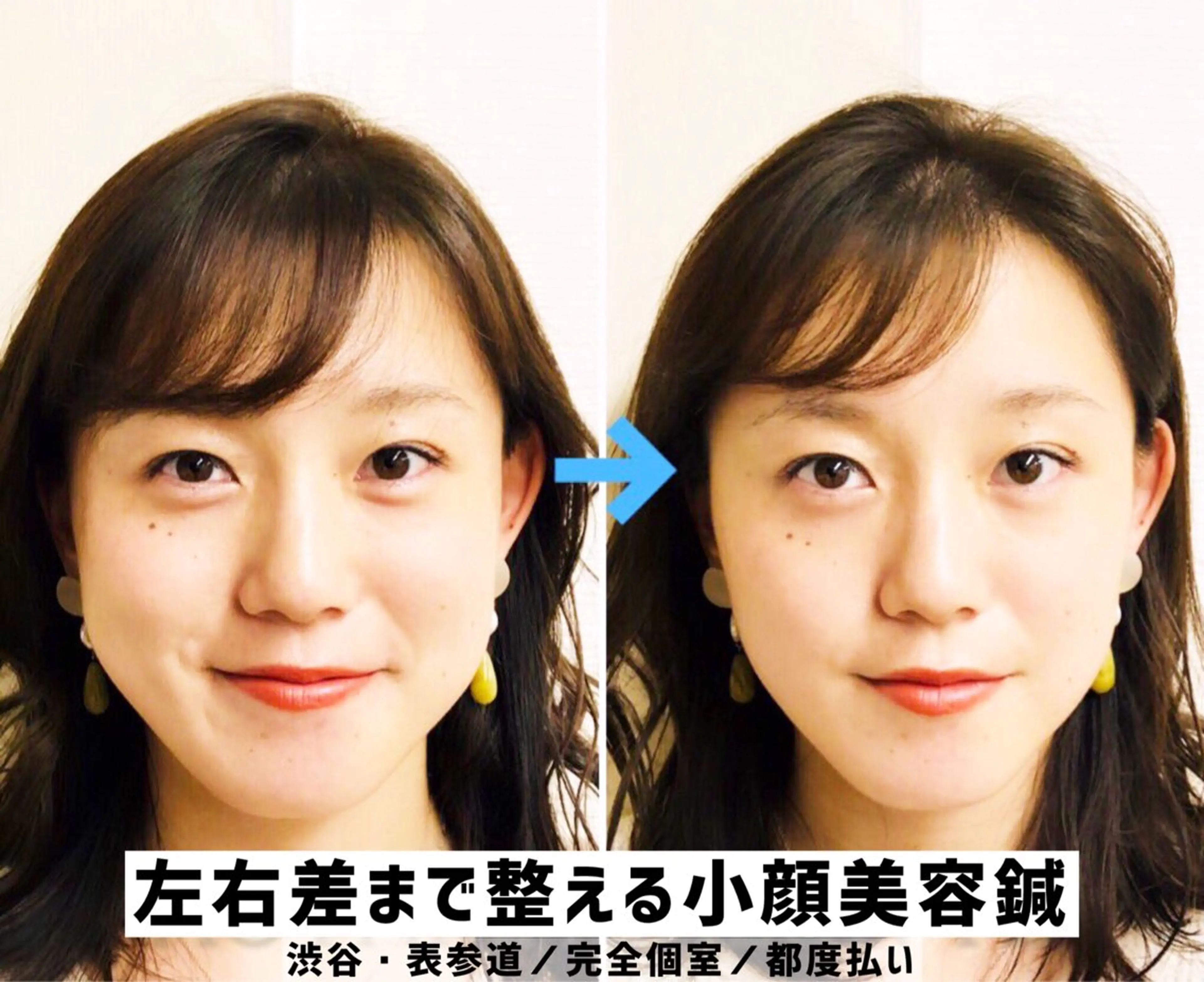 【最強フルコース👑】神小顔｜顔＋体=全身まとめて美容鍼90分の写真