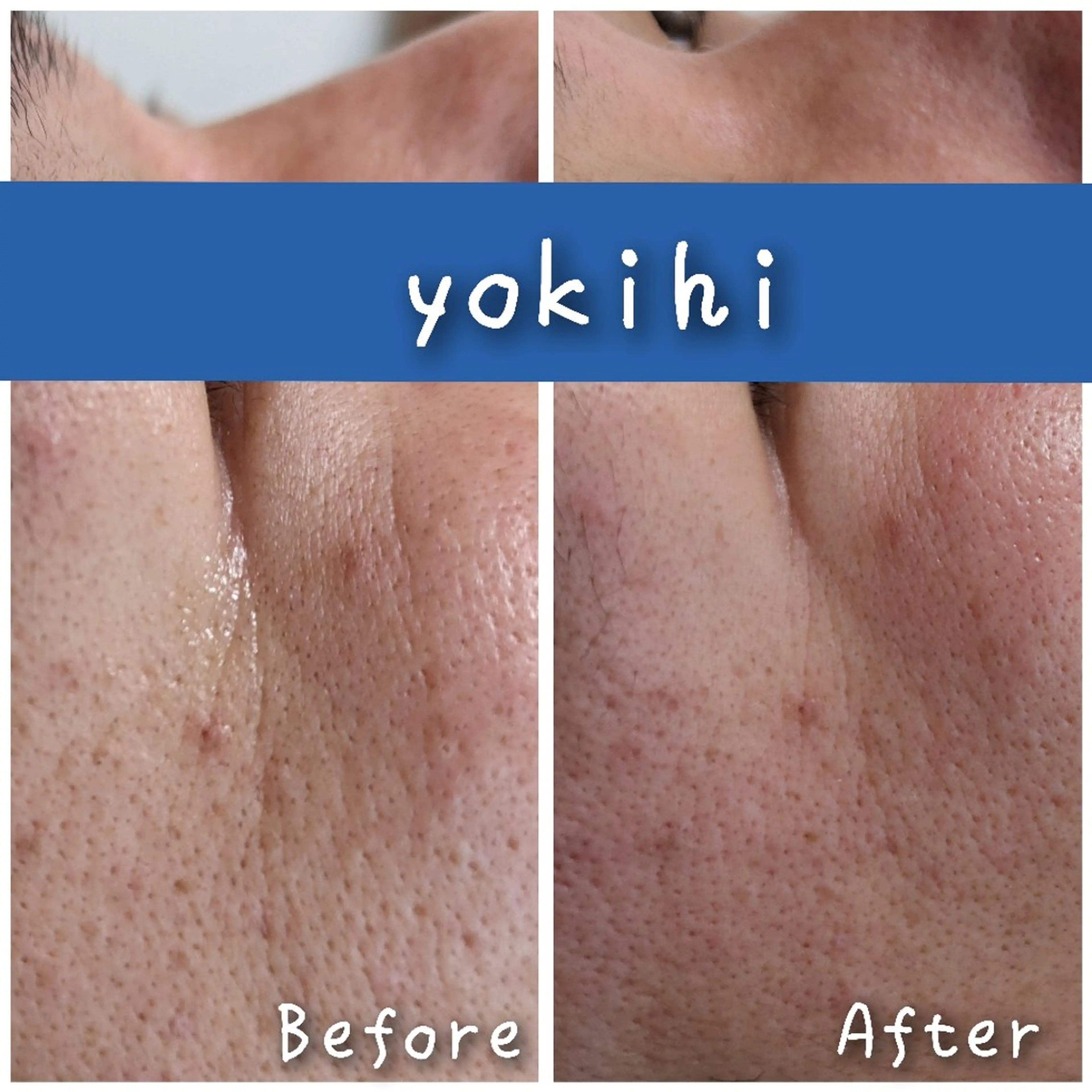 結果が出るスキンケア 肌質改善/まつパのエステ・リラクイメージ