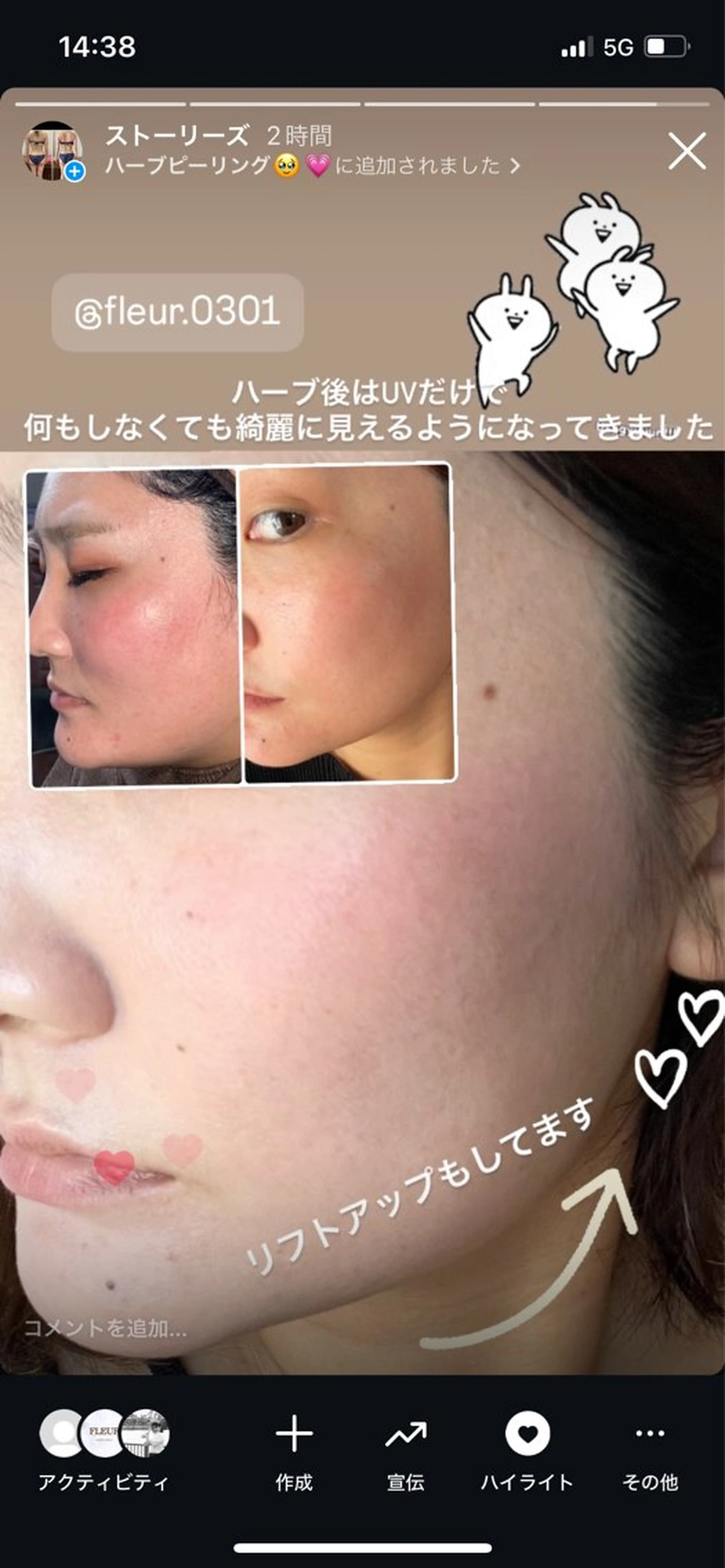 剥離あり🌿全顔ハーブピーリング😆💗医療提携サロン🫶肌を育てる喜びを🫶の写真