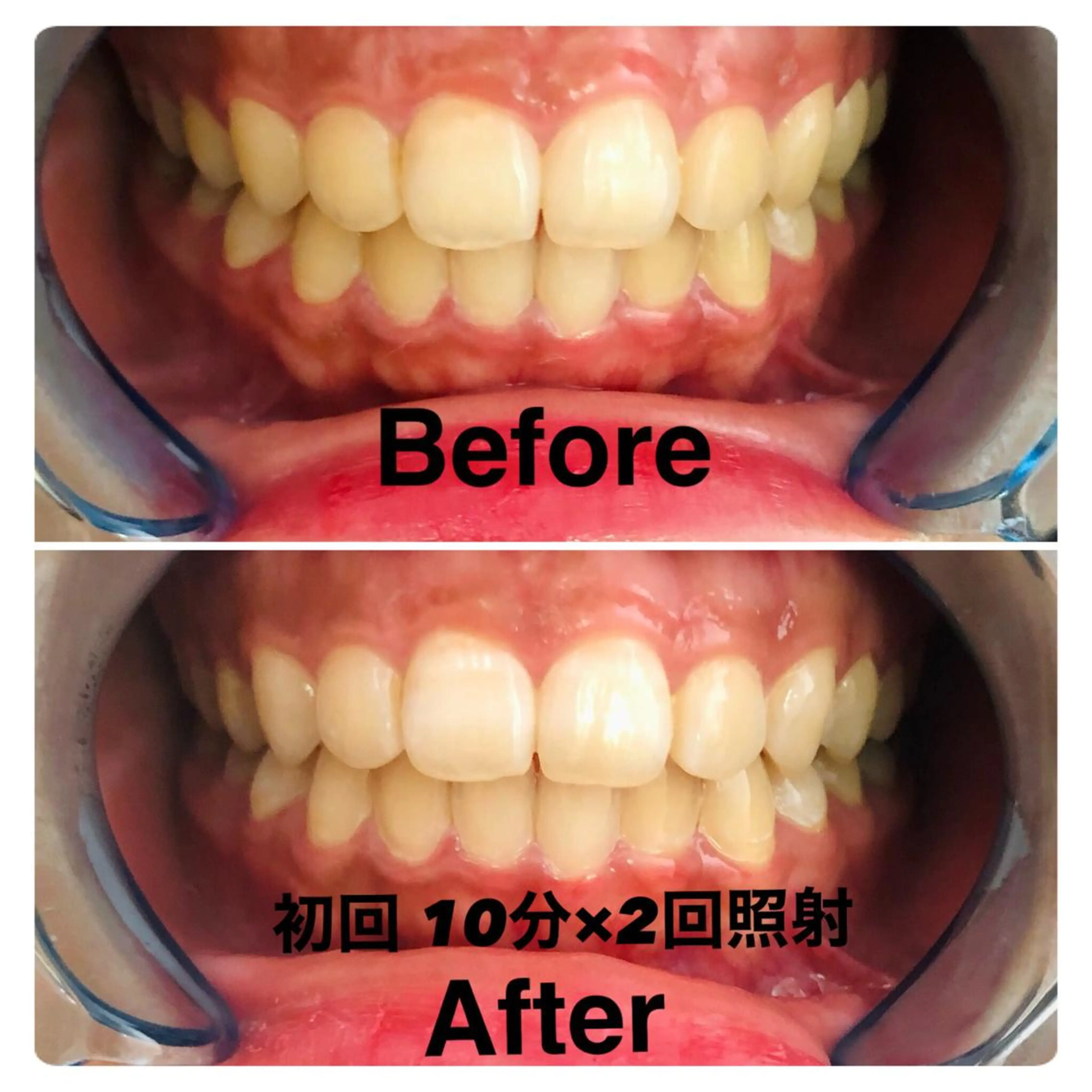 ホワイトニング回数券購入の方の写真