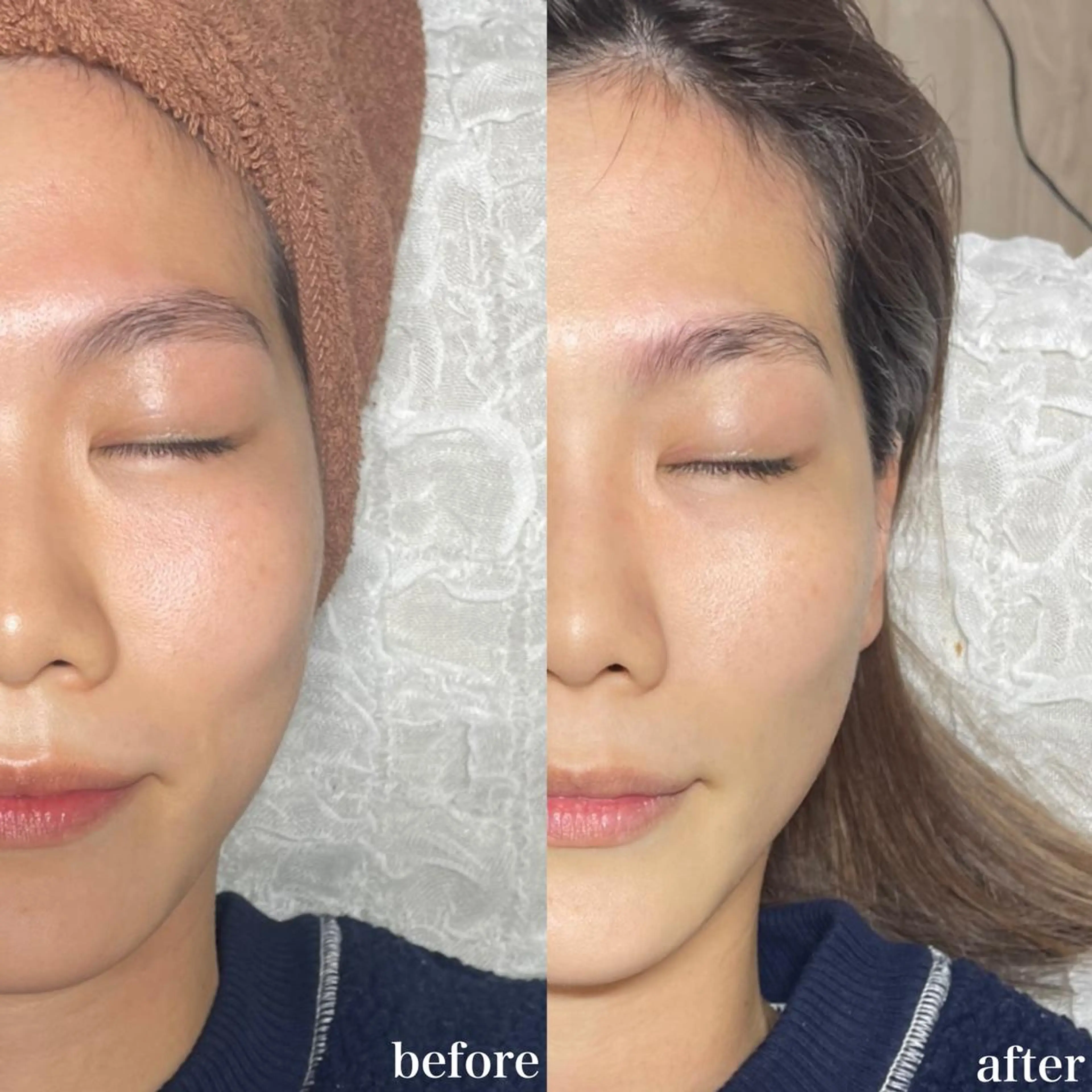 mieux所属・ハーブピーリング ¥6600のエステ・リラクイメージ