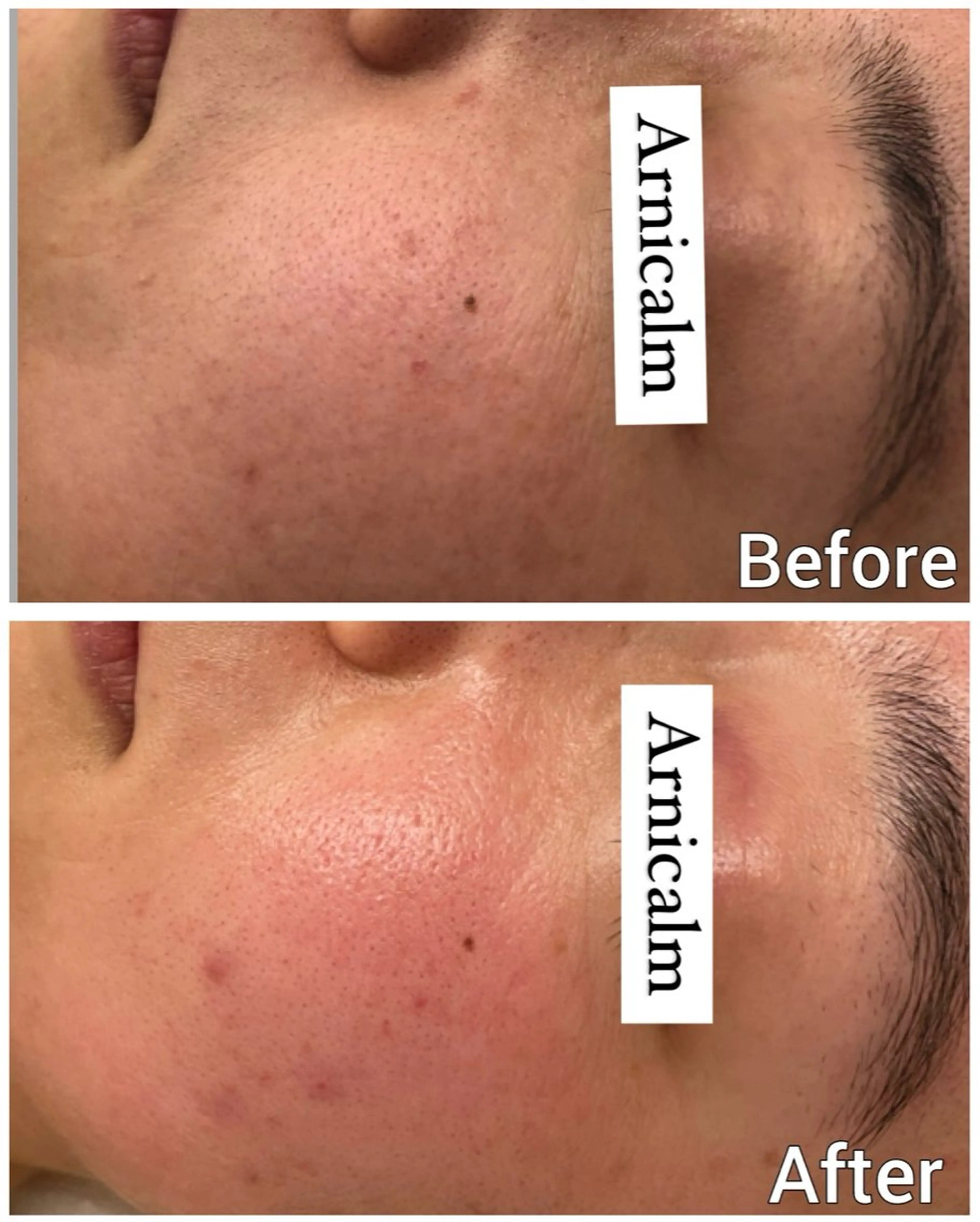 エステ ハーブピーリング 肌再生ピーリング/のエステ・リラクイメージ