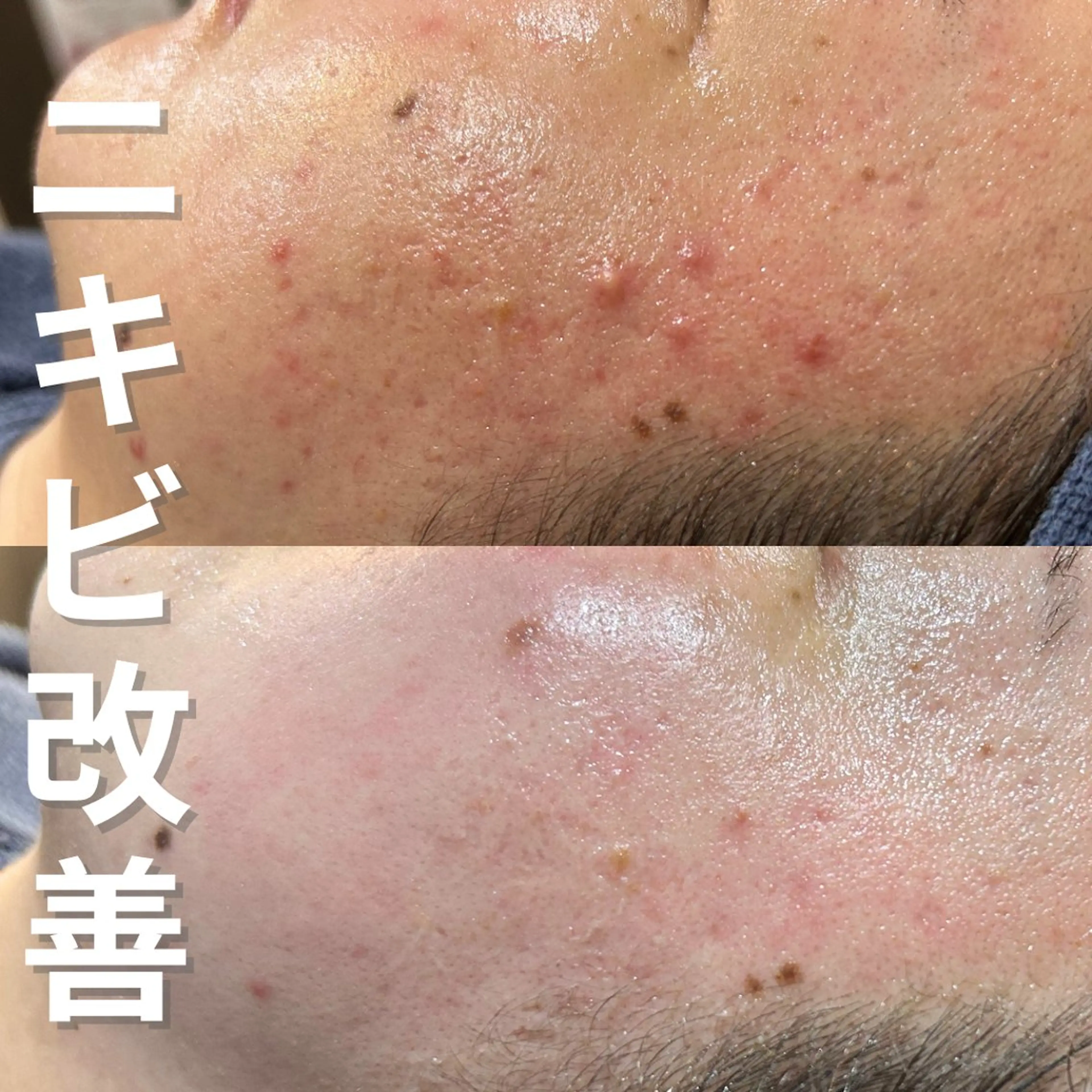 エステ ニキビ・ニキビ跡改善 leoloのエステ・リラクイメージ