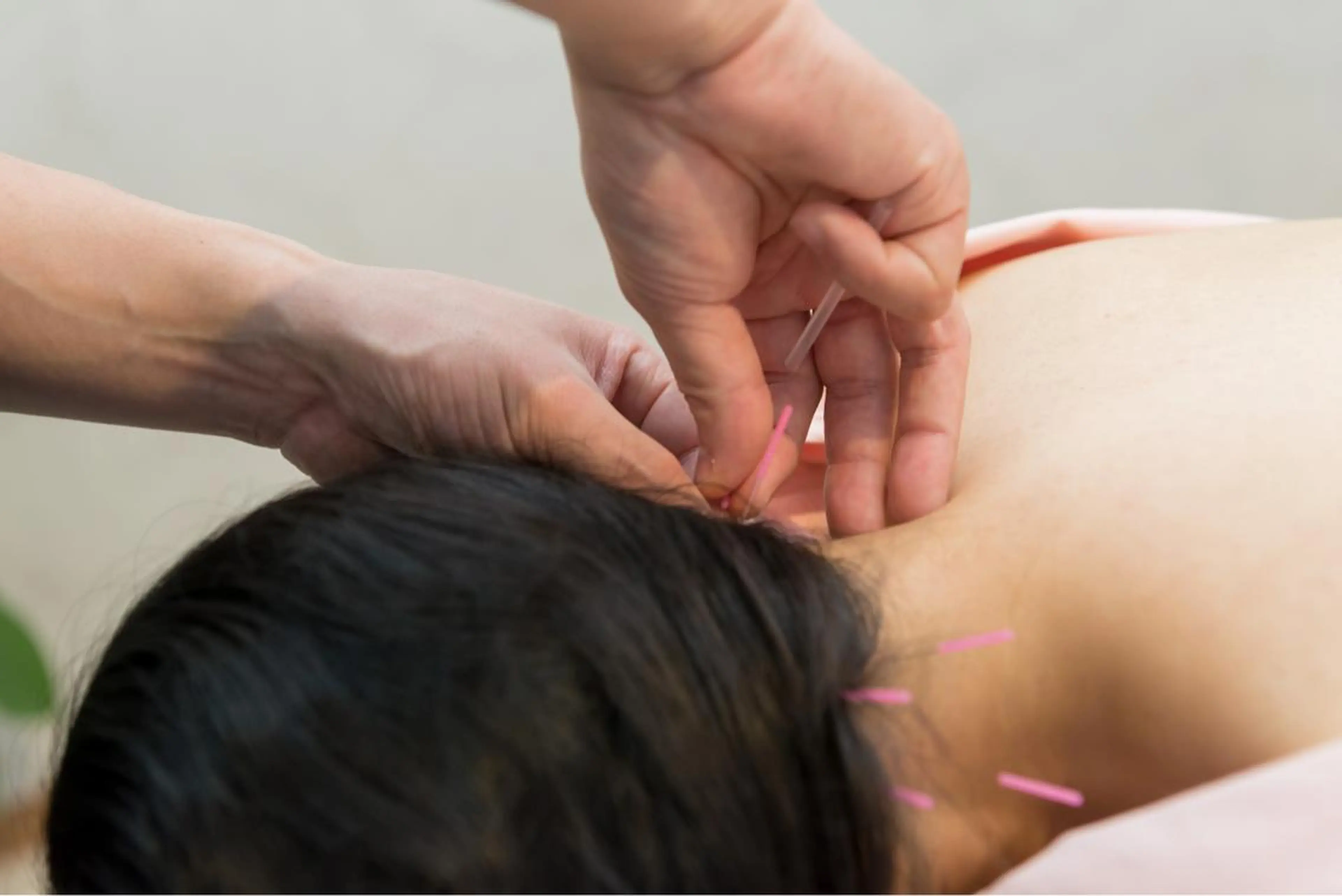 鍼灸施術​〜​首肩こり・腰痛などの体のケアに|メンズOKの写真