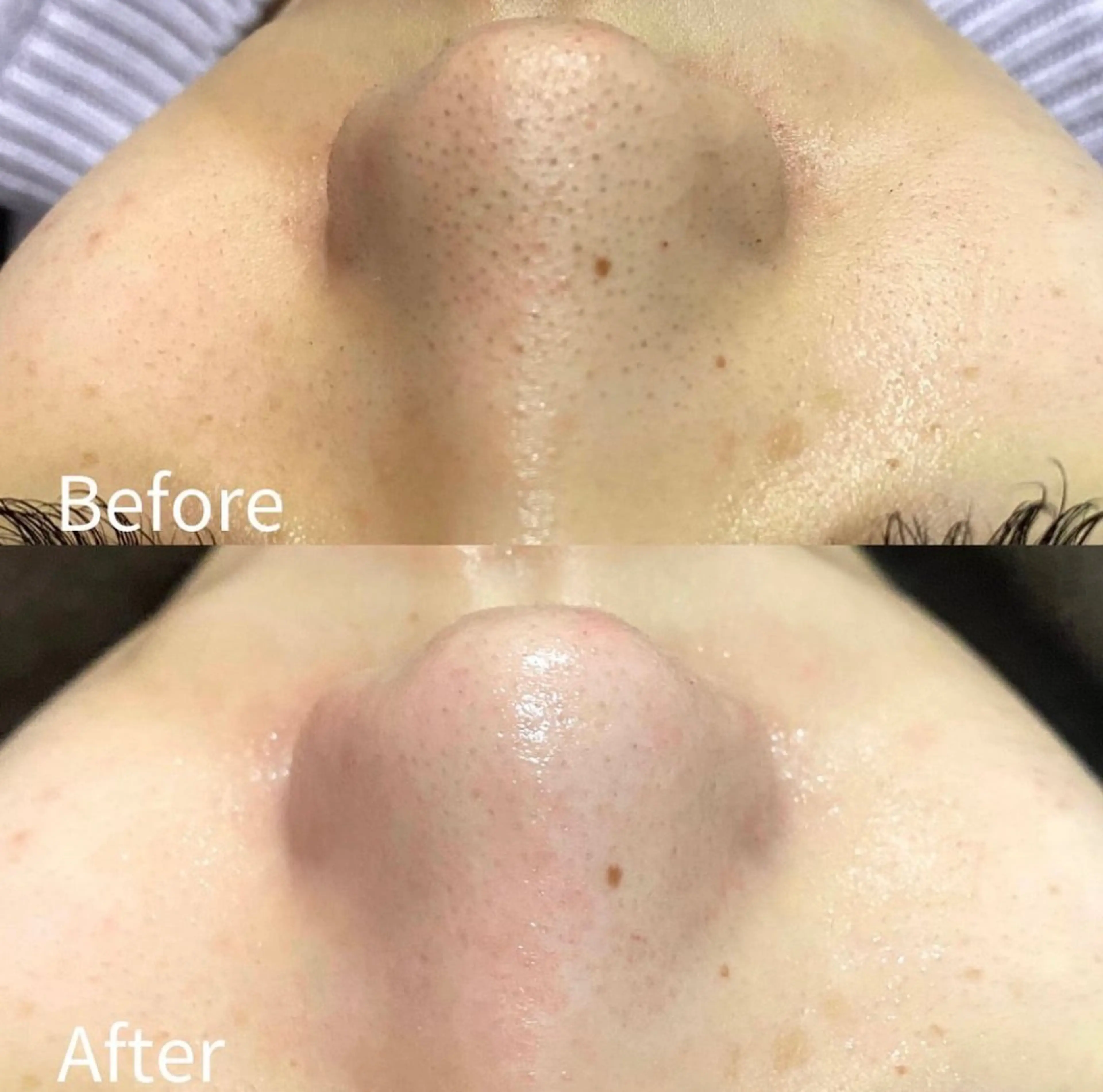 【人気No.1】ハイドロ毛穴洗浄×イオン導入 ¥11,000→¥6,980【口コミ割】の写真