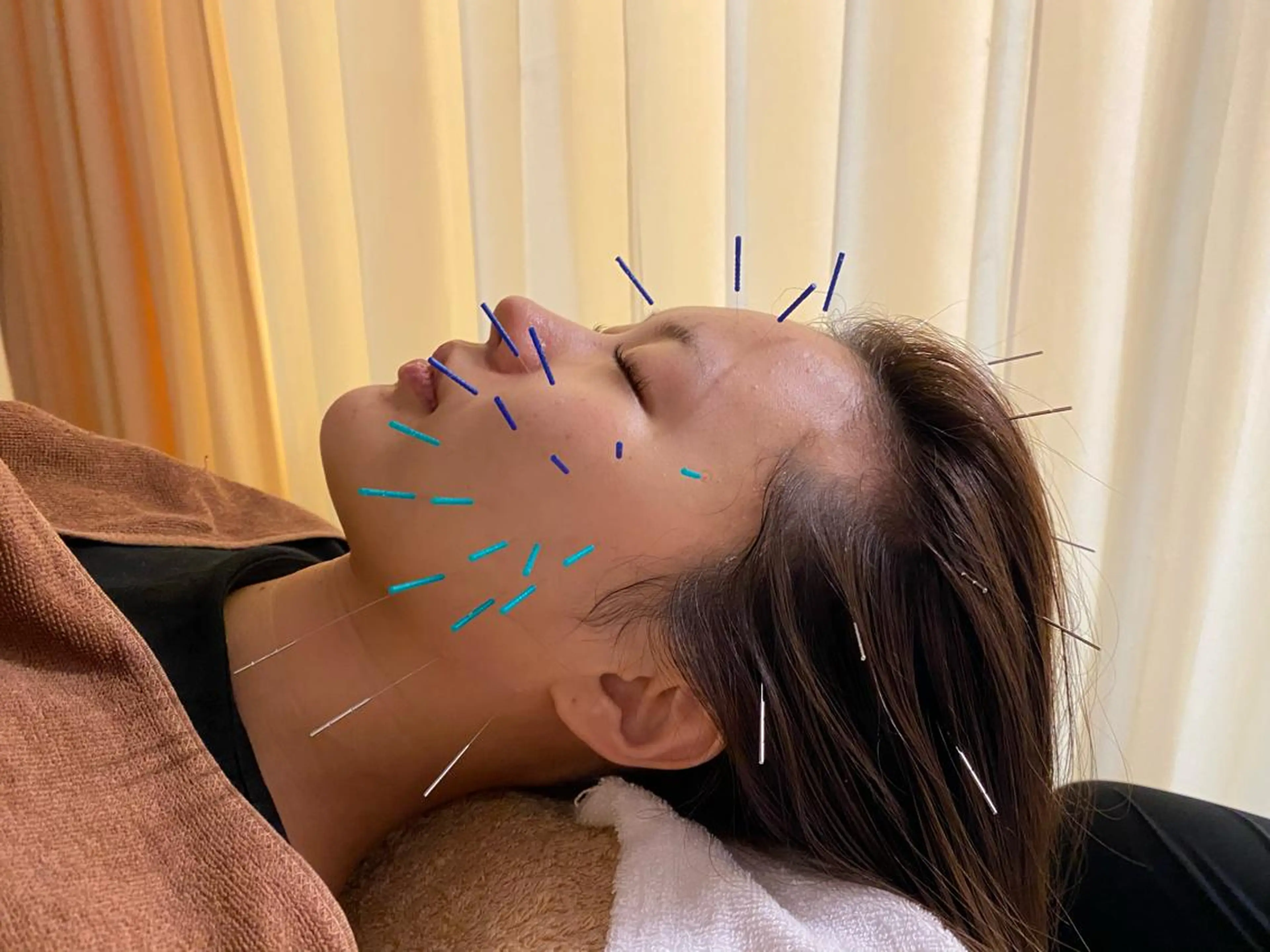 🌻小顔×肌質改善🌻美容鍼➕エステ➕筋肉ほぐしの写真