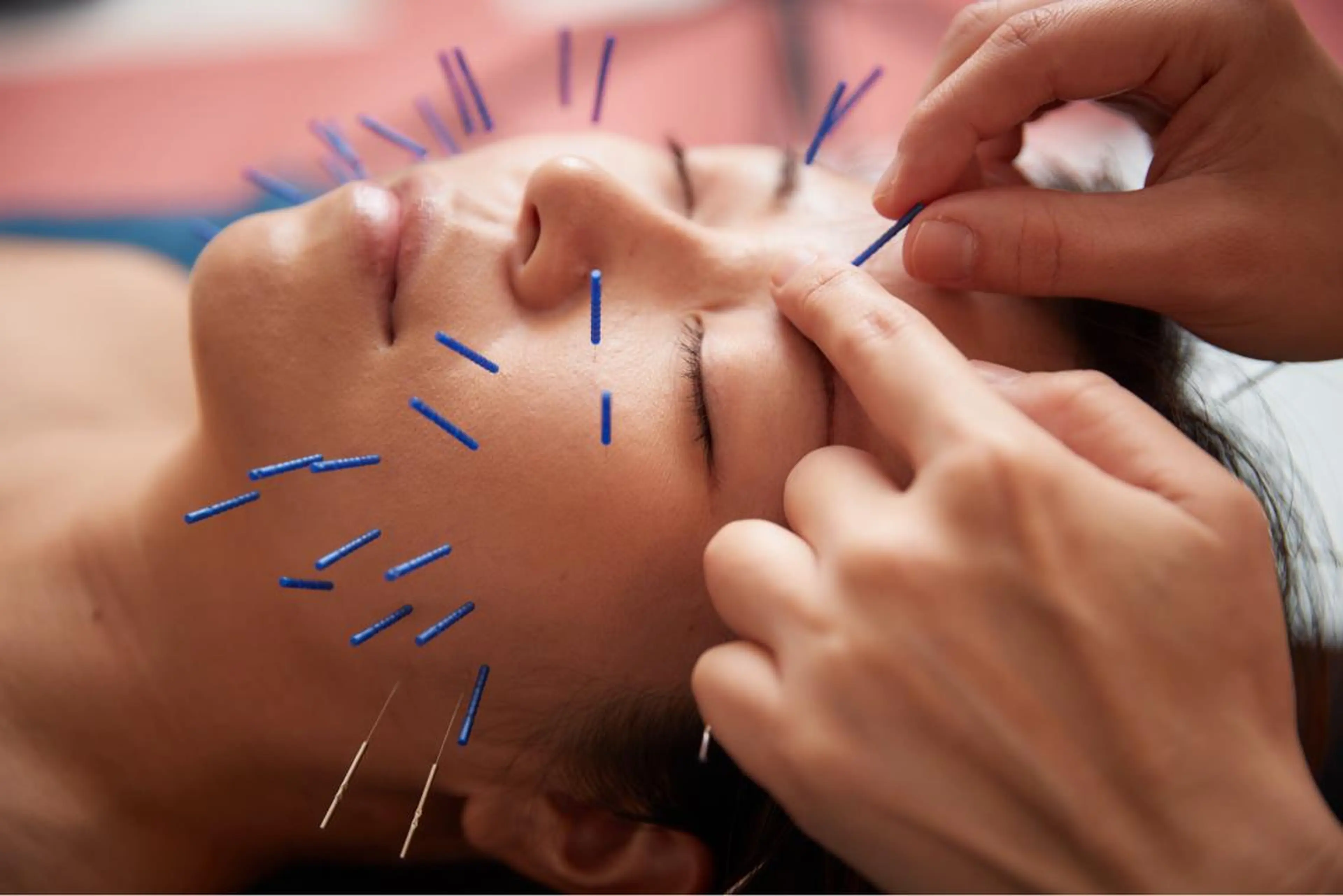 美楽鍼 びらくしんのその他イメージ