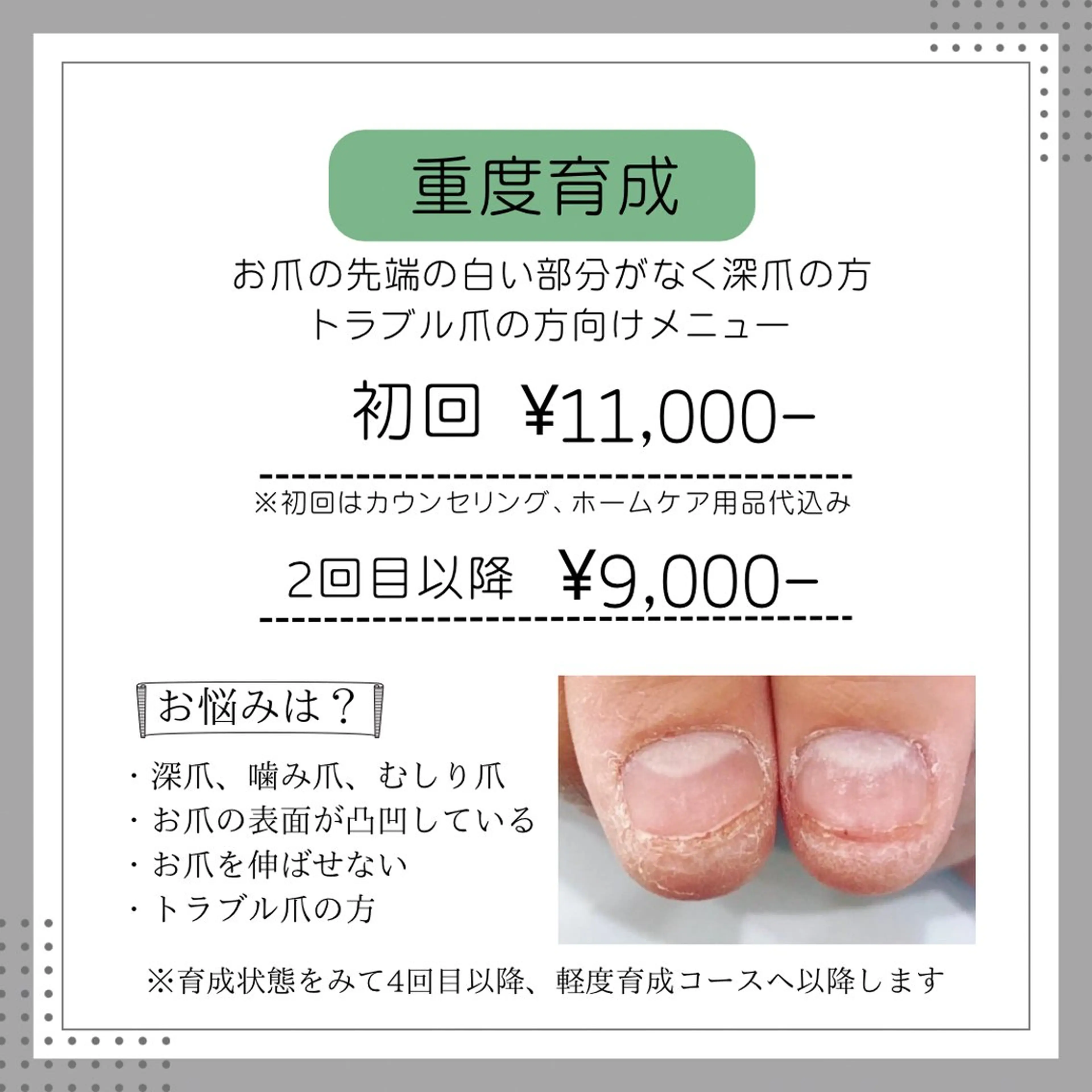 【重度】深爪、トラブル爪※初回ホームケアオイル込みの写真