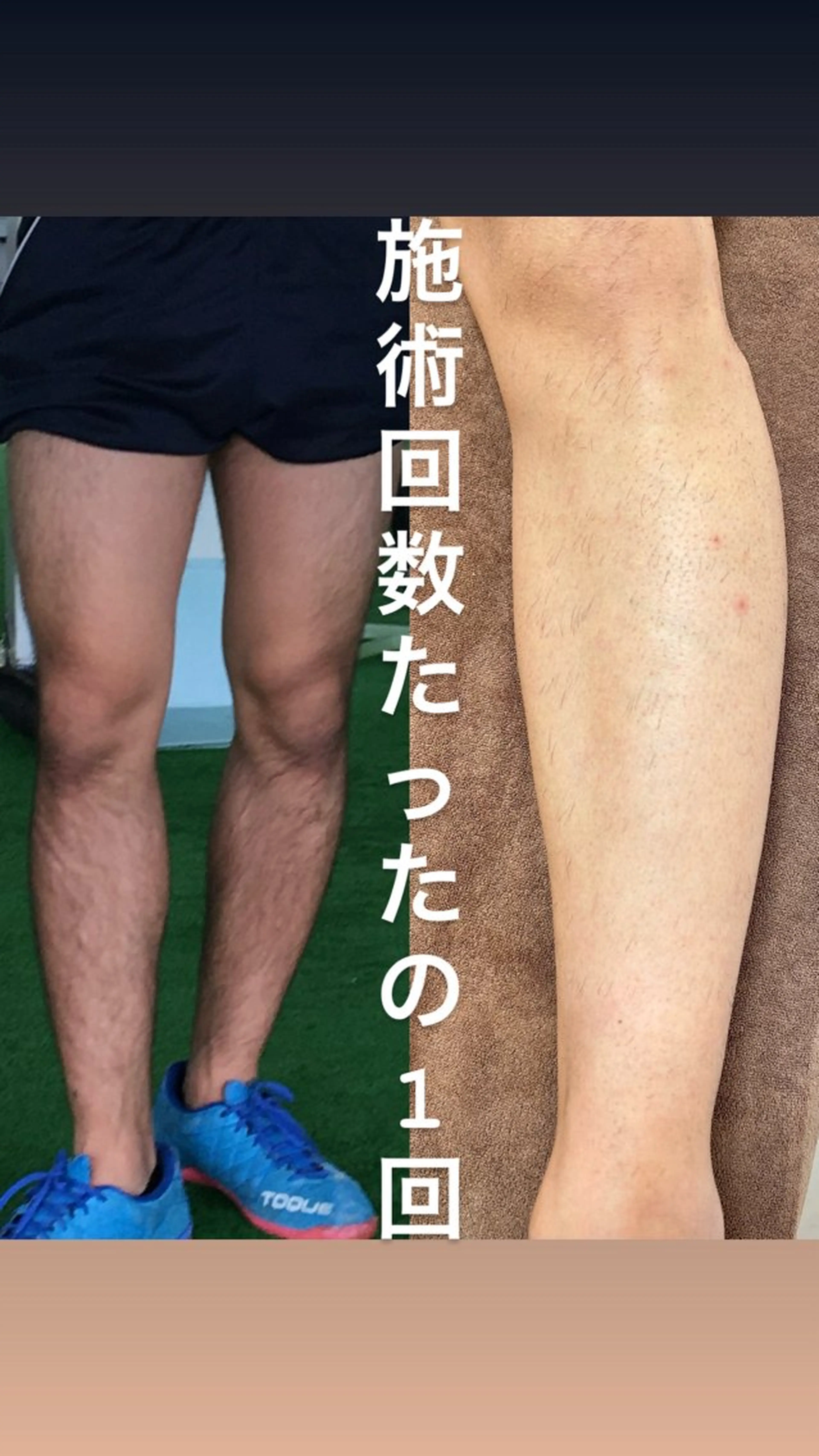 【人気No.③❗️】脚脱毛の写真
