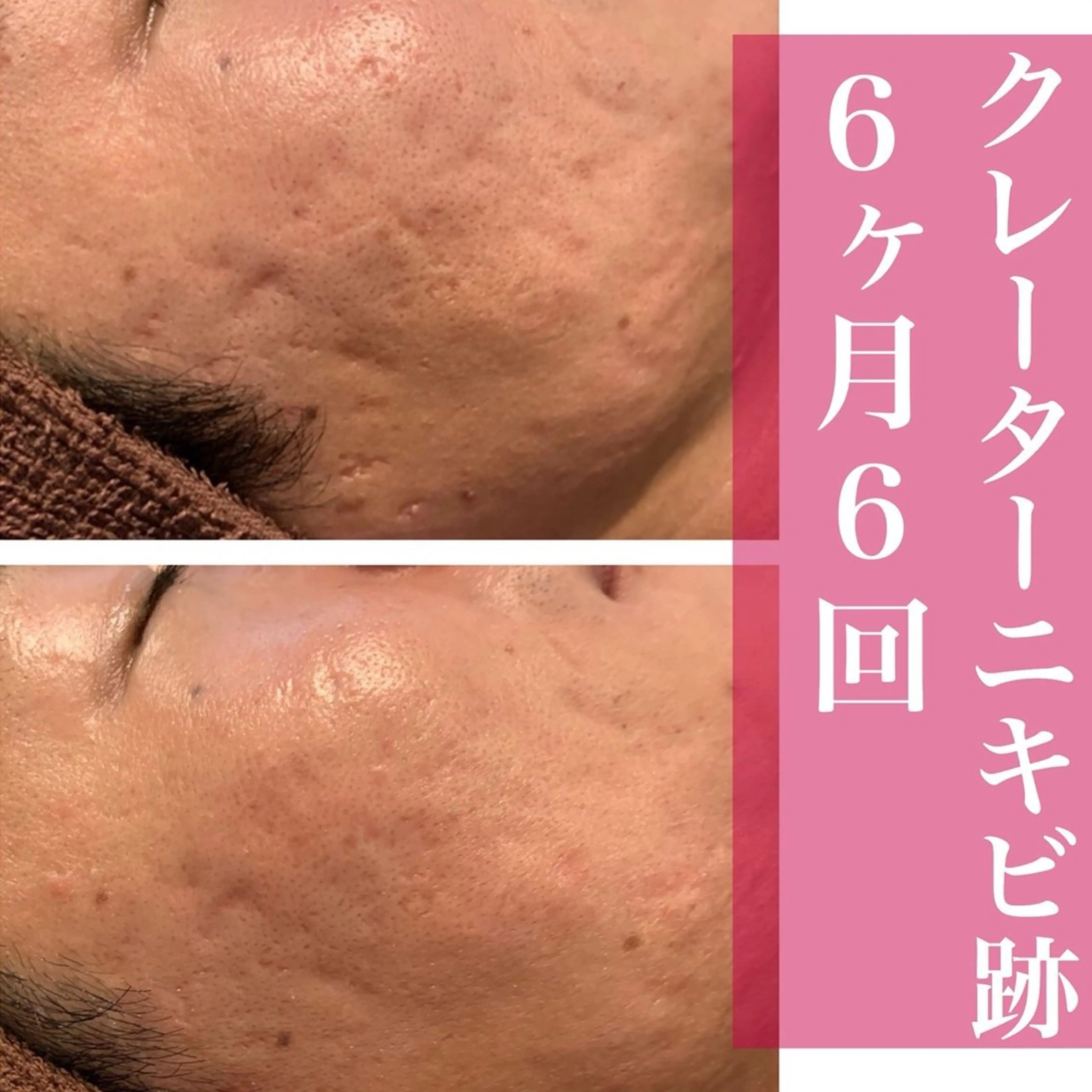 学生ニキビ改善🍀 優しい肌質改善のエステ・リラクイメージ