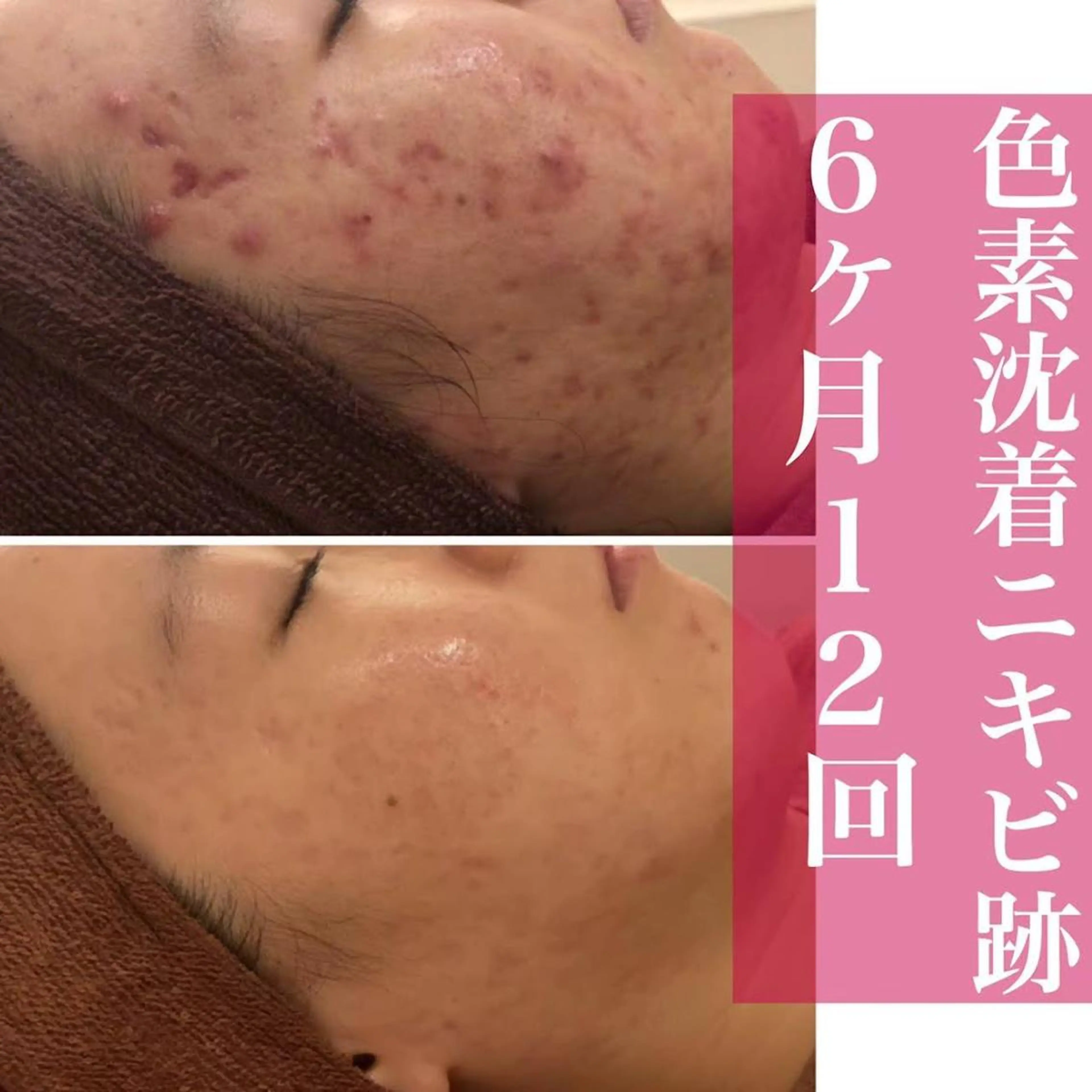 ロング カラー パーマ ヘアアレンジ メンズ キッズ ネイル マツエク・マツパ 都内で出来る肌管理！ 最短ニキビ改善のエステ・リラクイメージ