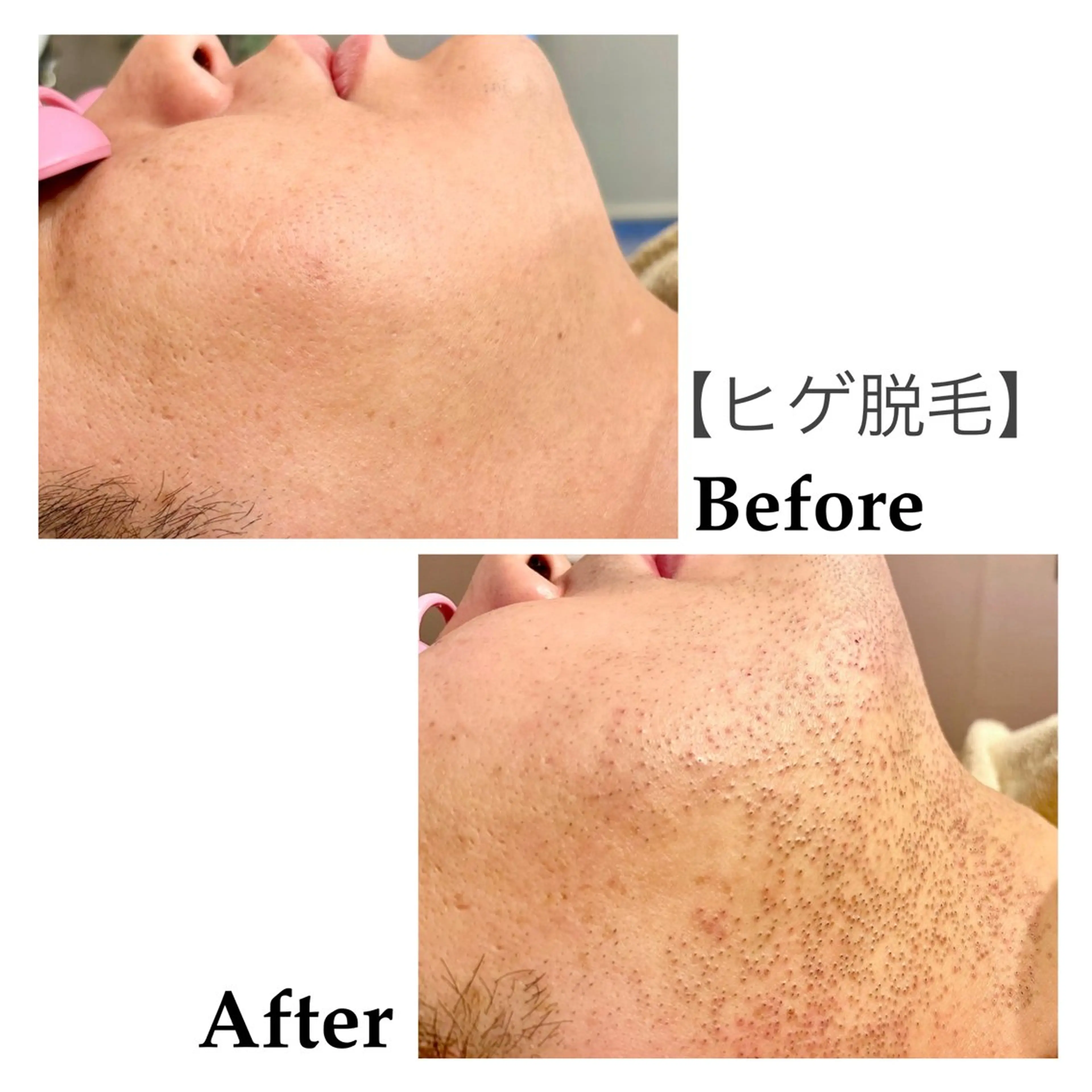 メンズ 脱毛 脱毛サロンFIS【新宿店】所属・堺 祐季奈のエステ・リラクイメージ