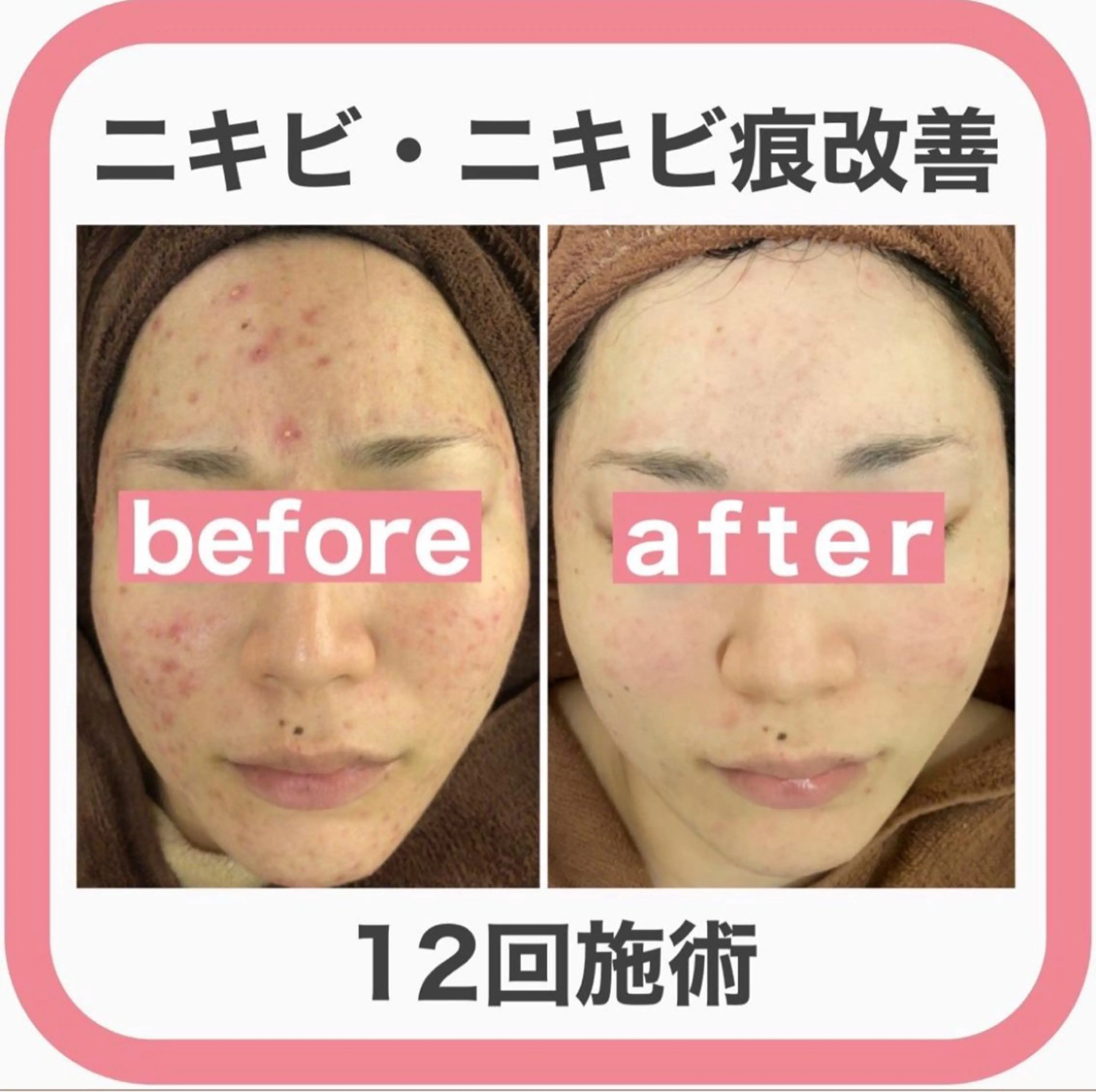 学生ニキビ改善🍀 優しい肌質改善のエステ・リラクイメージ