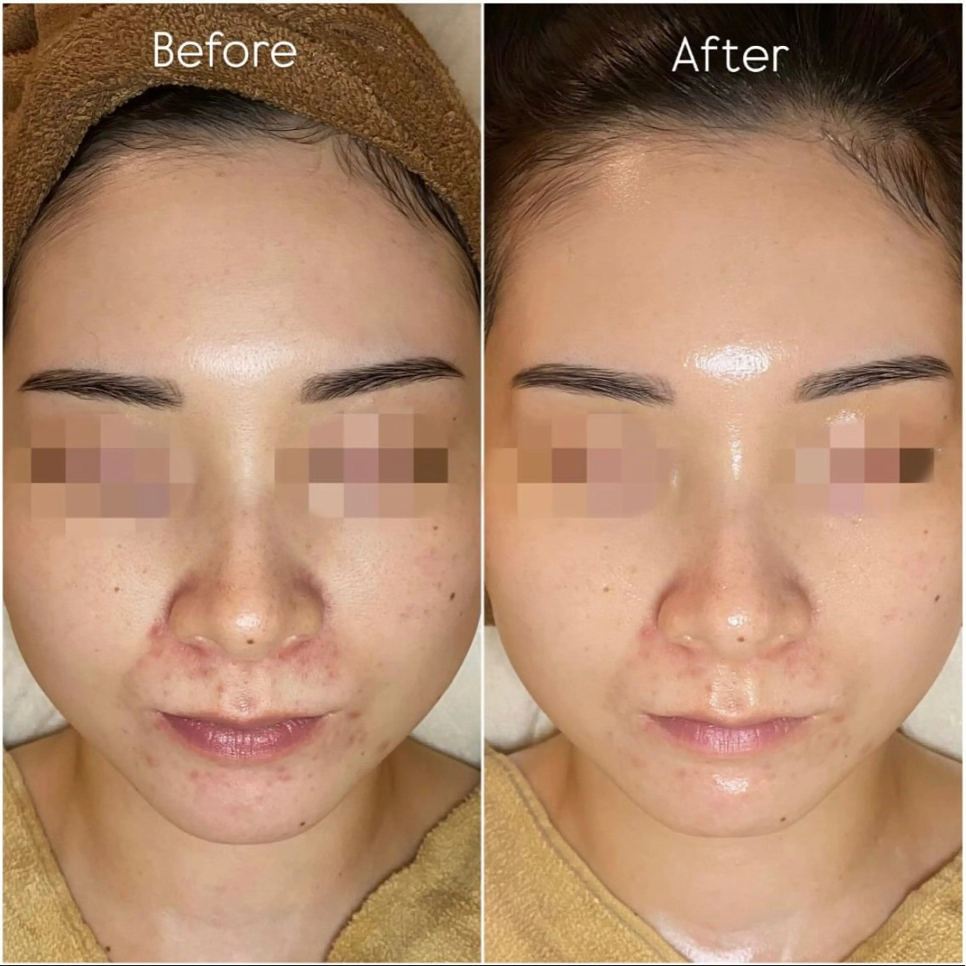 エステ エステサロン-mignon-所属・mignon 脱毛/ ローマピンク/耳ツボのその他イメージ