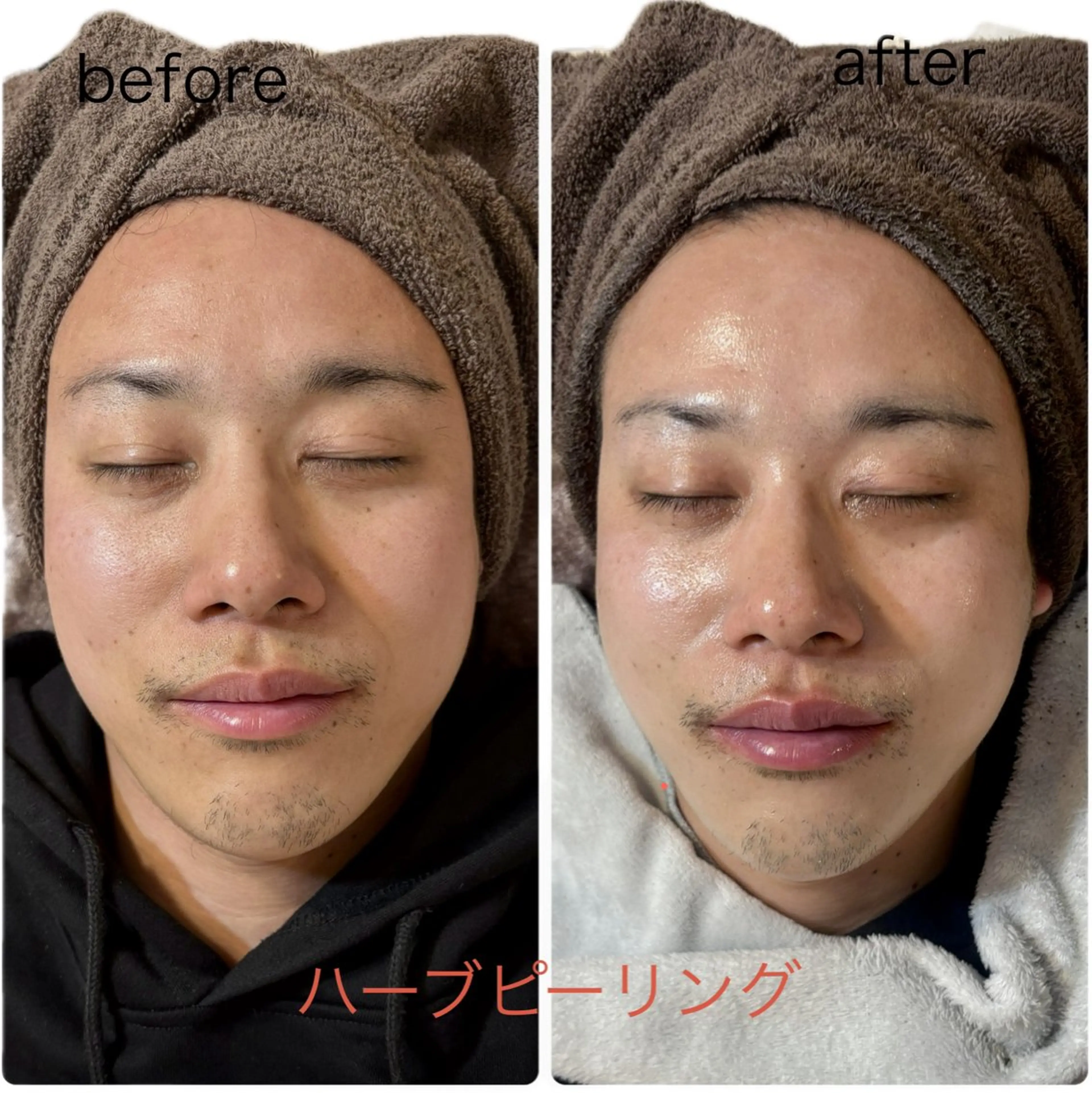 エステ ハーブピーリング/韓国肌管理/フェイシャル/毛穴洗浄/眉毛/顔脱毛【糸脱毛専門】rev所属・ハーブピーリング専門 毛穴洗浄❤️眉waxのエステ・リラクイメージ