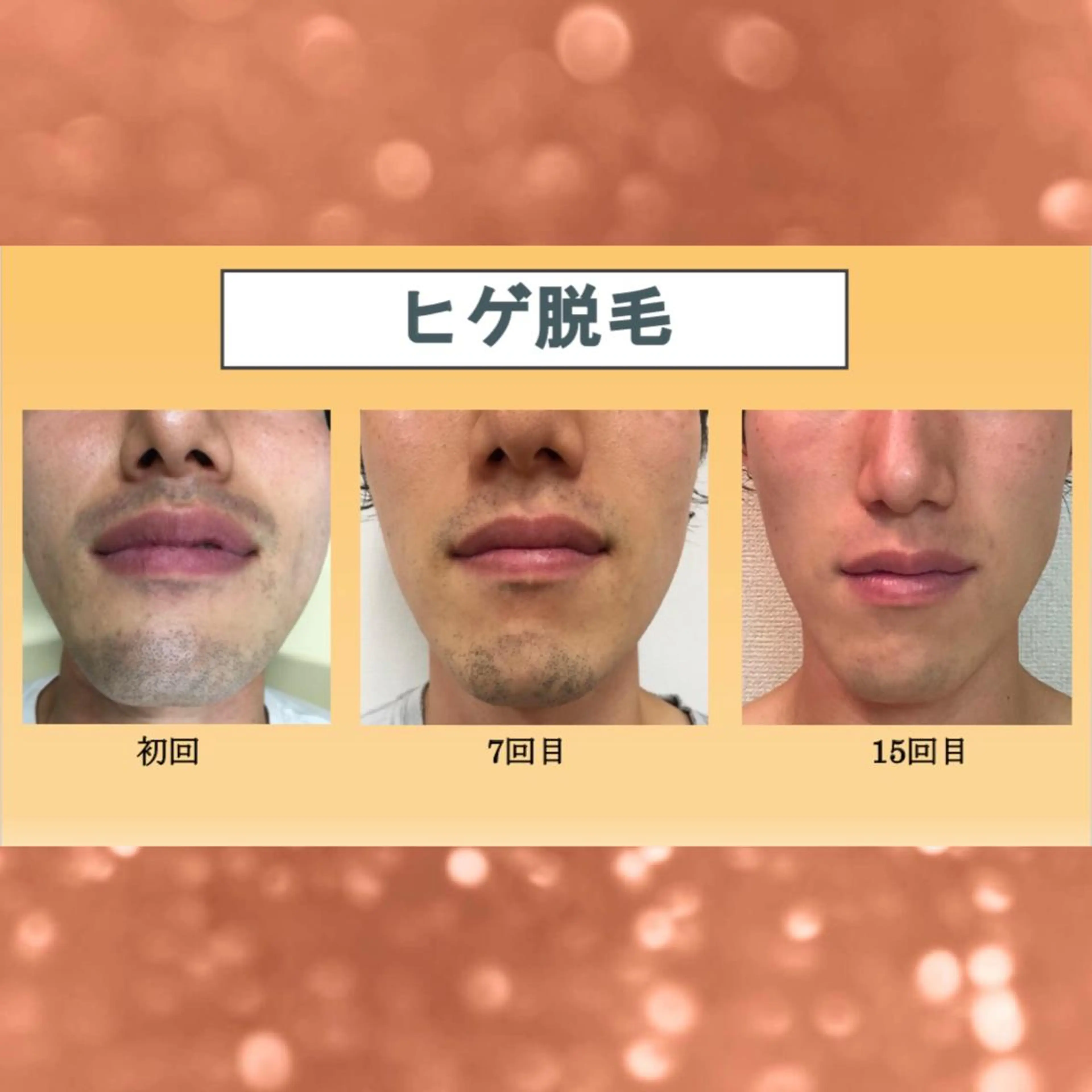 脱毛 脱毛サロン NR エヌアール所属・NR Nara yukiのエステ・リラクイメージ