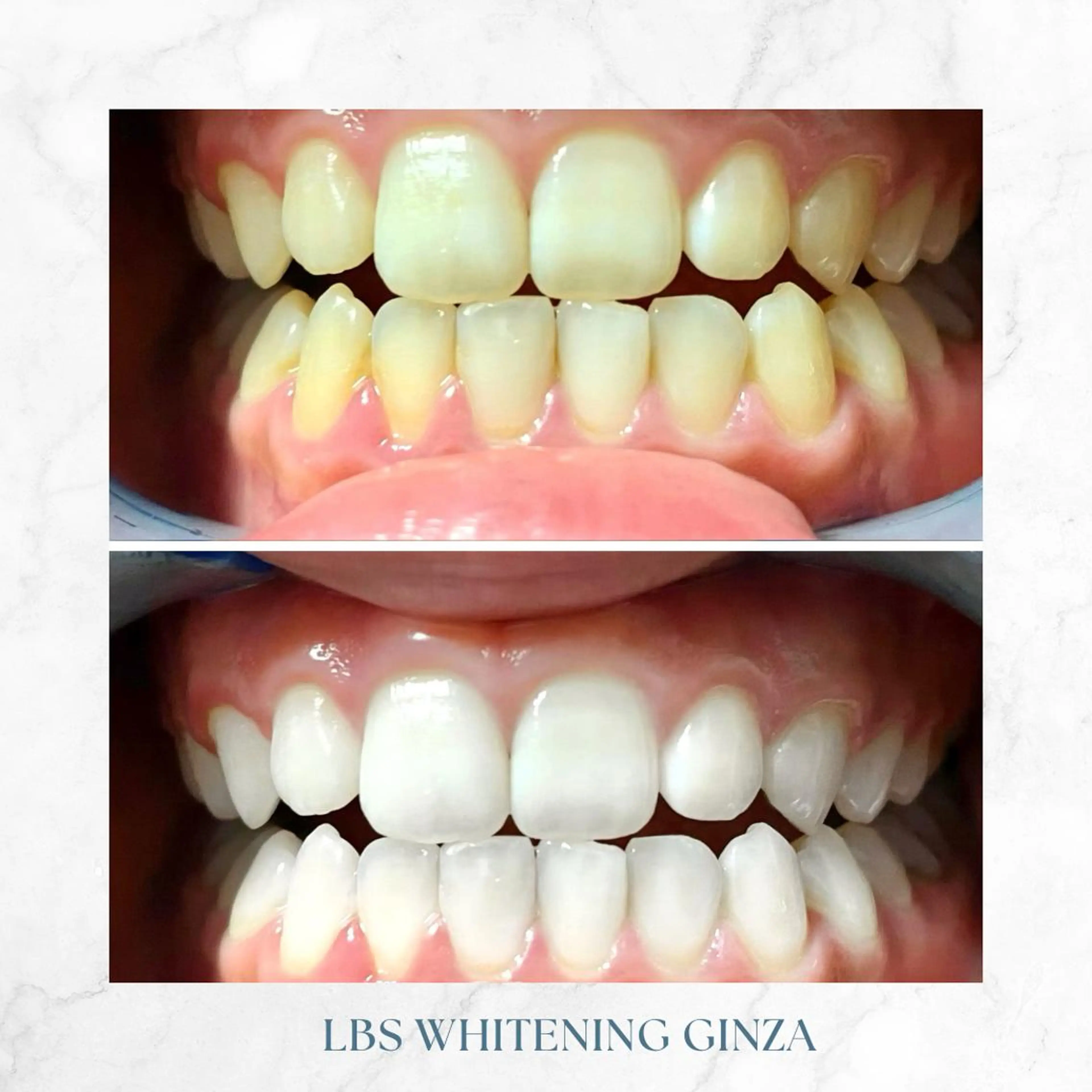 メンズ その他 LBSホワイトニング 銀座店💎公式のその他イメージ