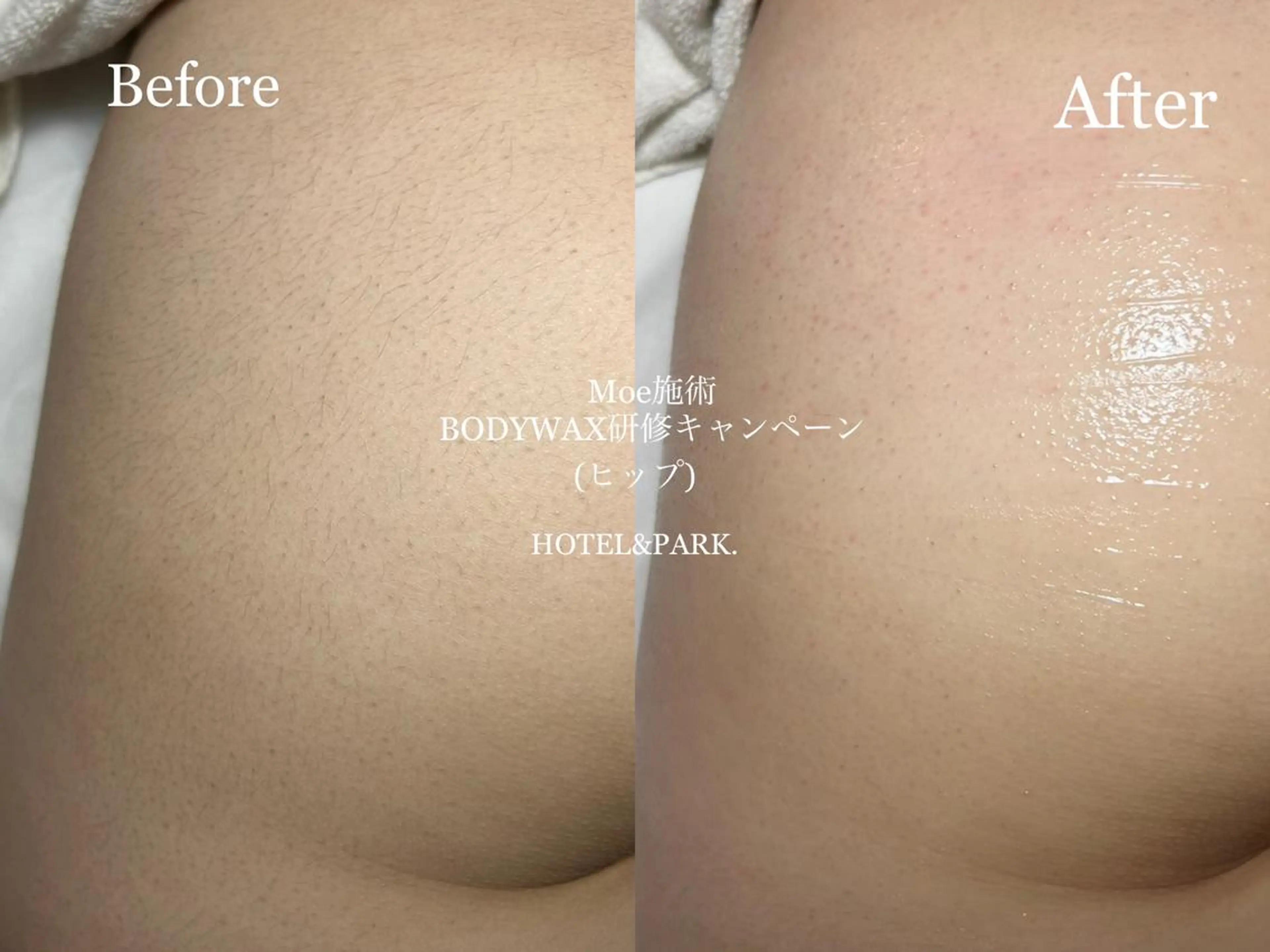 HOTEL&PARK . ワックス脱毛のエステ・リラクイメージ