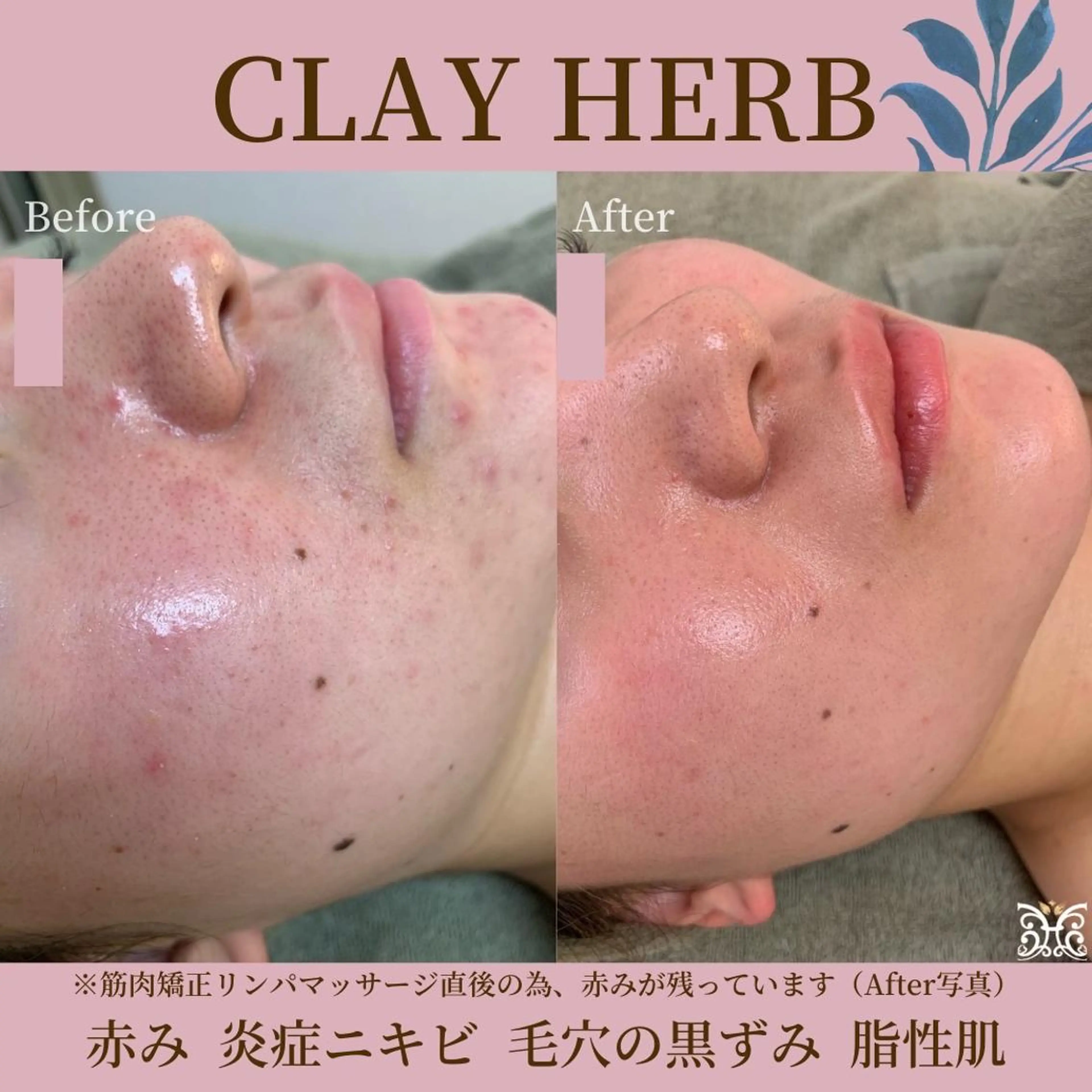 エステ リラク 【剥離ありハーブピーリング専門エステ】cerisier BEAUTÉ 原宿所属・cerisier BEAUTÉのエステ・リラクイメージ