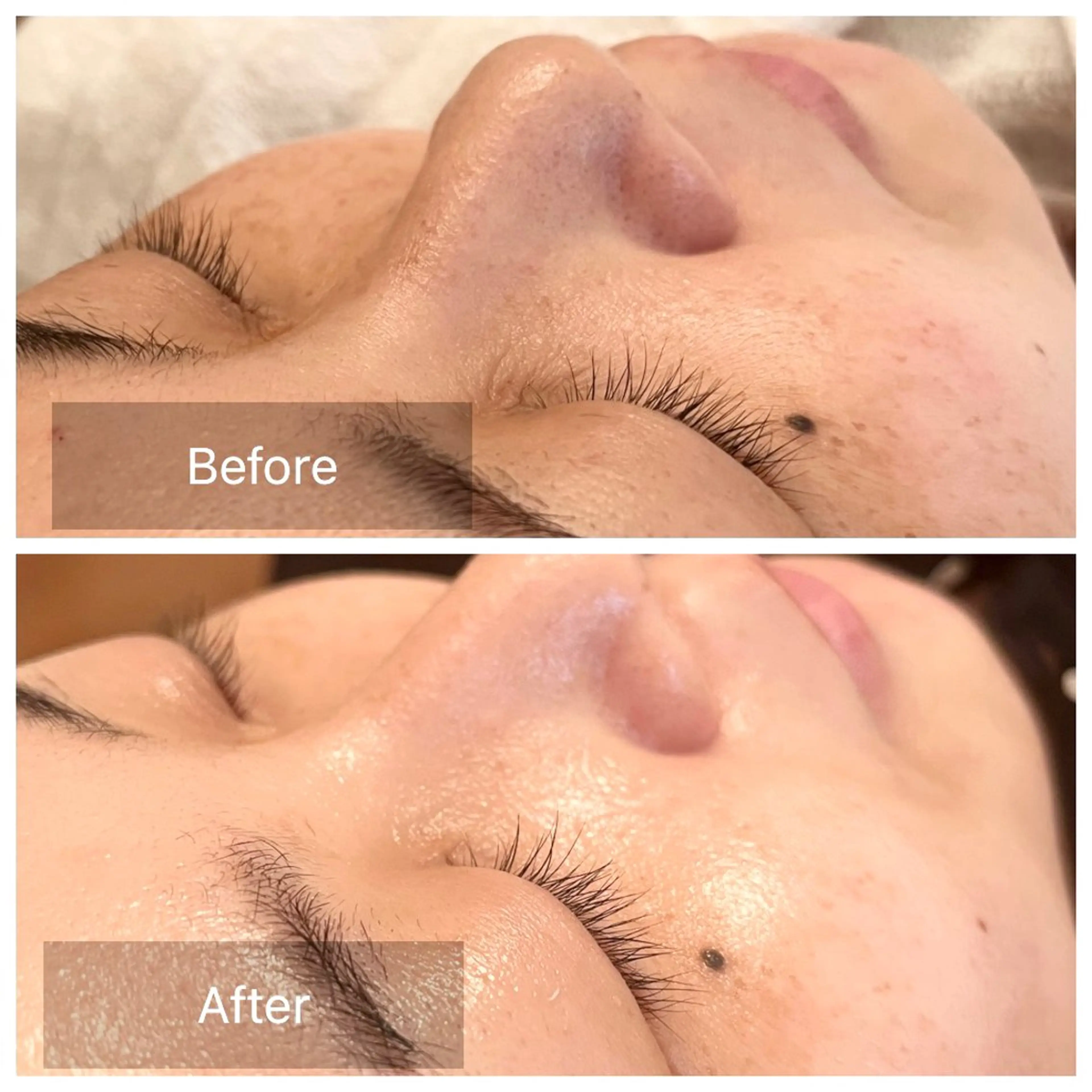 【つや・小顔・美白】初回オススメ🔰つや肌重視コース！塗るヒアルロン酸でつやっ✨触りたくなるお肌に❣️の写真